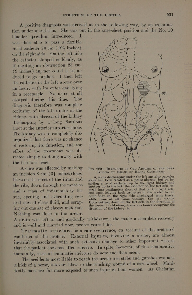 tion under anesthesia. bladder speculum introduced. I was then able to pass a flexible renal catheter 26 cm. (104 inches) on the right side. On the left side the catheter stopped suddenly, as if meeting an obstruction 23 cm. (9 inches) in, nor could it be in- duced to go farther. I then left the catheter in the left ureter over an hour, with its outer end lying in a receptacle. No urine at all escaped during this time. The diagnosis therefore was complete occlusion of the left ureter at the kidney, with abscess of the kidney discharging by a long fistulous tract at the anterior superior spine. The kidney was so completely dis- organized that there was no chance of restoring its function, and the effort of the treatment was di- rected simply to doing away with the fistulous tract. A cure was effected by making an incision 8 em. (34 inches) long, between the crest of the ilium and the ribs, down through the muscles and a mass of inflammatory tis- sue, opening and evacuating sev- eral sacs of clear fluid, and serap- ing out one sac of cheesy material. Nothing was done to the ureter. Fig. 289.—D1acGnosis oF OLD ABSCESS OF THE LEFT KIpNEY BY MEANS OF RENAL CATHETERS. A, sinus discharging under the left anterior superior spine had been treated as a psoas abscess, but on in- serting a renal catheter up to the right kidney and another up to the left, the catheter on the left side en- tered four centimeters short of that on the right side, and upon leaving both catheters in the ureter for an hour, that on the right side discharged urine freely, while none at all came through the left ureter. Upon cutting down on the left side in the direction of the arrow, an old cheesy focus was found occupying the situation of the kidney, A. condition of the ureters.