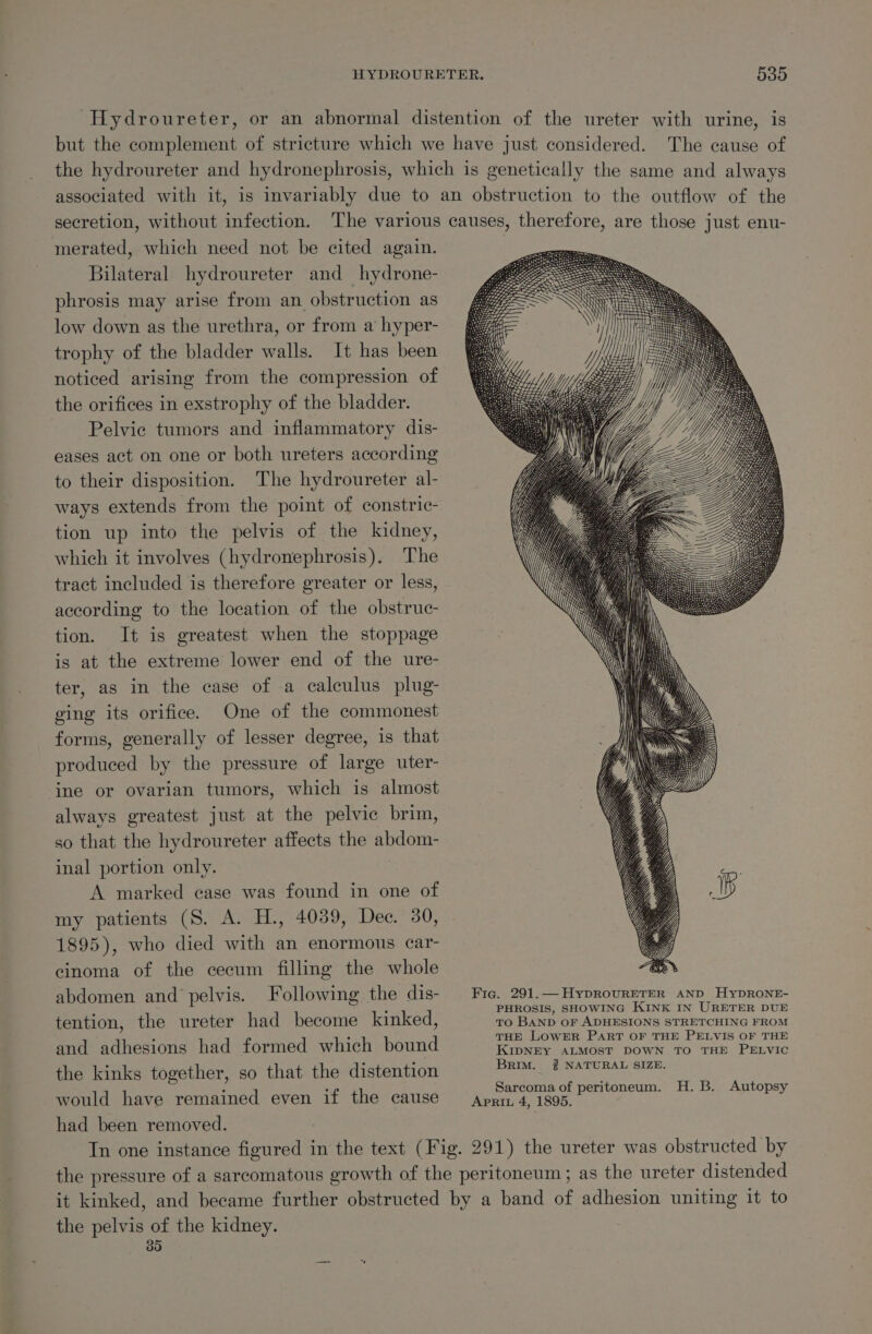 Hydroureter, or an abnormal distention of the ureter with urine, is but the complement of stricture which we have just considered. The cause of the hydroureter and hydronephrosis, which is genetically the same and always associated with it, is invariably due to an obstruction to the outflow of the secretion, without infection. The various causes, therefore, are those just enu- merated, which need not be cited again. Bilateral hydroureter and hydrone- phrosis may arise from an obstruction as low down as the urethra, or from a hyper- trophy of the bladder walls. It has been noticed arising from the compression of the orifices in exstrophy of the bladder. Pelvic tumors and inflammatory dis- eases act on one or both ureters according to their disposition. The hydroureter al- ways extends from the point of constric- tion up into the pelvis of the kidney, which it involves (hydronephrosis). The tract included is therefore greater or less, according to the location of the obstruc- tion. It is greatest when the stoppage is at the extreme lower end of the ure- ter, as in the case of a calculus plug- ging its orifice. One of the commonest forms, generally of lesser degree, is that produced by the pressure of large uter- ine or ovarian tumors, which is almost always greatest just at the pelvic brim, so that the hydroureter affects the abdom- inal portion only. : A marked case was found in one of my patients (S. A. H., 4039, Dec. 30, 1895), who died with an enormous car- cinoma of the cecum filling the whole abdomen and pelvis. Following the dis- Fig. 291.— HypROURETER AND HyDRONE- : PHROSIS, SHOWING KINK IN URETER DUE tention, the ureter had become kinked, To BAND OF ADHESIONS STRETCHING FROM A : THE LOWER PART OF THE PELVIS OF THE and adhesions had formed which bound es ae Ga a oak Pienae . . . ay = the kinks together, so that the distention Ue SERA Let. i t S f perit oA Bos Aut would have remained even if the cause Apri4,1895.) utopsy had been removed. Tn one instance figured in the text (Fig. 291) the ureter was obstructed by the pressure of a sarcomatous growth of the peritoneum; as the ureter distended it kinked, and became further obstructed by a band of adhesion uniting it to the pelvis of the kidney. 30