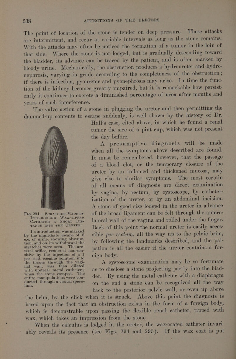 The point of location of the stone is tender on deep pressure. These attacks are intermittent, and recur at variable intervals as long as the stone remains. With the attacks may often be noticed the formation of a tumor in the loin of that side. Where the stone is not lodged, but is gradually descending toward the bladder, its advance can be traced by the patient, and is often marked by~ bloody urine. Mechanically, the obstruction produces a hydroureter and hydro- nephrosis, varying in grade according to the completeness of the obstruction ; if there is infection, pyoureter and pyonephrosis may arise. In time the func- tion of the kidney becomes greatly impaired, but it is remarkable how persist- ently it continues to excrete a diminished percentage of urea after months and years of such interference. The valve action of a stone in plugging the ureter and then permitting the dammed-up contents to escape suddenly, is well shown by the history opel: Hall’s case, cited above, in which he found a renal tumor the size of a pint cup, which was not present the day before. A presumptive diagnosis will be made when all the symptoms above described are found. Tt must be remembered, however, that the passage of a blood clot, or the temporary closure of the ureter by an inflamed and thickened mucosa, may give rise to similar symptoms. The most certain of all means of diagnosis are direct examination by vagina, by rectum, by cystoscope, by catheter- ization of the ureter, or by an abdominal incision. A stone of good size lodged in the ureter in advance of the broad ligament can be felt through the antero- lateral wall of the vagina and rolled under the finger. Fig. 294.—ScratTcHEes MApf BY INTRODUCING WaAX-TIPPED CATHETER A SuHoRT Dis- TANCE INTO THE URETER. Its introduction was marked by the immediate escape of 8 c.c. of urine, showing obstruc- tion, and on its withdrawal the scratches were seen. ‘The ure- teral orifice, rendered non-sen- sitive by the injection of a 1 per cent cocaine solution into the tissues through the vagi- nal wall, was then dilated with ureteral metal catheters, when the stone escaped. The entire manipulations were con- ducted through a vesical specu- lum. Back of this point the normal ureter is easily acces- sible per rectum, all the way up to the pelvic brim, by following the landmarks described, and the pal- pation is all the easier if the ureter contains a for- eign body. | A eystoscopic examination may be so fortunate as to disclose a stone projecting partly into the blad- der. By using the metal catheter with a diaphragm on the end a stone can be recognized all the way back to the posterior pelvic wall, or even up above the brim, by the click when it is struck. Above this point the diagnosis 1s based upon the fact that an obstruction exists in the form of a foreign body, which is demonstrable upon passing the flexible renal catheter, tipped with wax, which takes an impression from the stone. When the calculus is lodged in the ureter, the wax-coated catheter invari- ably reveals its presence (see Figs. 294 and 295). If the wax coat is put