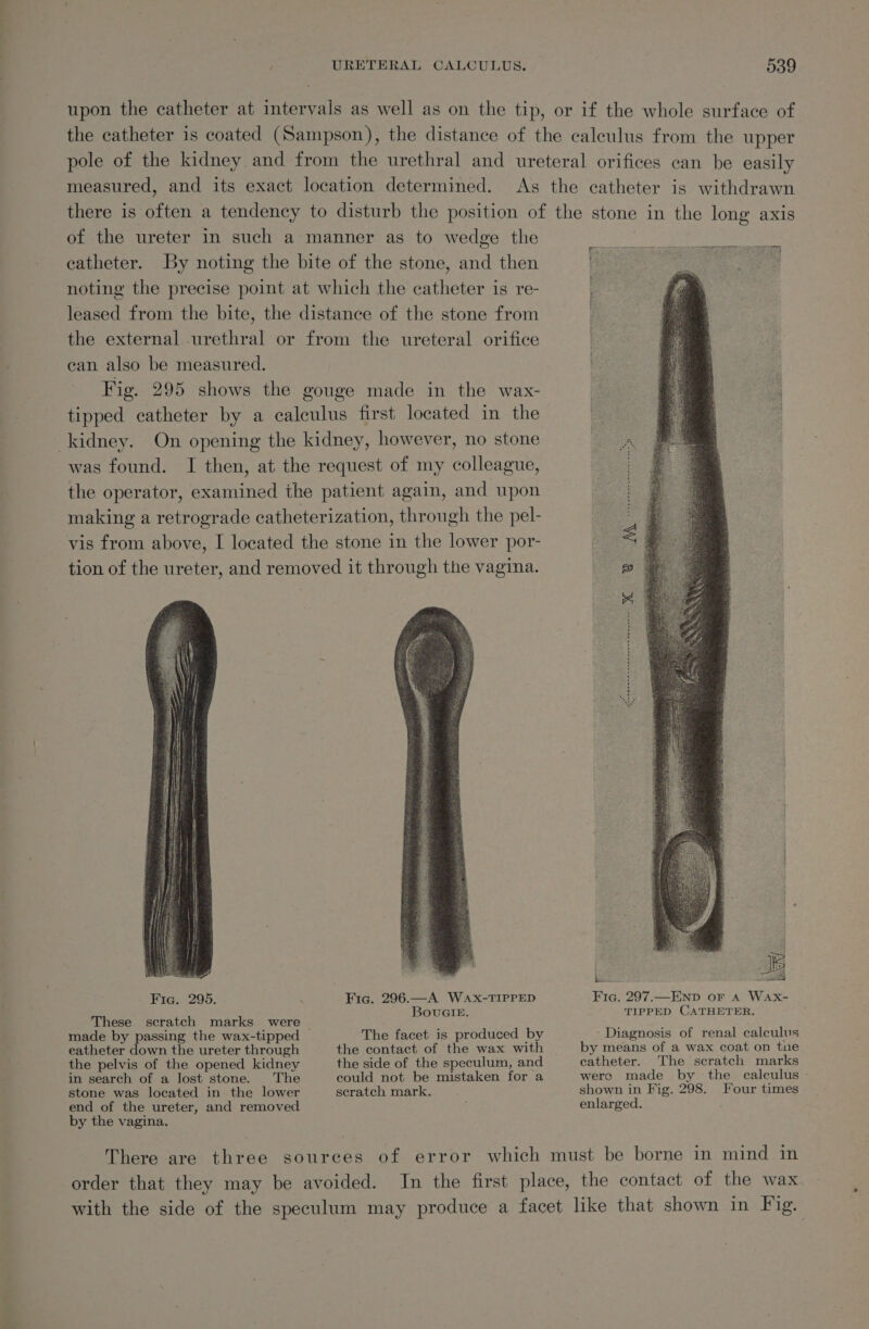 of the ureter in such a manner as to wedge the catheter. By noting the bite of the stone, and then noting the precise point at which the catheter is re- leased from the bite, the distance of the stone from the external urethral or from the ureteral orifice can also be measured. Fig. 295 shows the gouge made in the wax- tipped catheter by a calculus first located in the kidney. On opening the kidney, however, no stone was found. I then, at the request of my colleague, the operator, examined the patient again, and upon making a retrograde catheterization, through the pel- vis from above, I located the stone in the lower por- tion of the ureter, and removed it through the vagina. Fic. 295. Fig. 296.—A Wax-TIPPED BouGiez. These scratch marks were _ made by passing the wax-tipped The facet is produced by eatheter down the ureter through the contact of the wax with the pelvis of the opened kidney the side of the speculum, and in search of a lost stone. The could not be mistaken for a stone was located in. the lower scratch mark. end of the ureter, and removed by the vagina. SRN SIN SE ae ce | 7] Sea ard wee) Fic. 297.—END oF A Wax- TIPPED CATHETER. Diagnosis of renal calculus by means of a wax coat on tne catheter. The scratch marks were made by the calculus - shown in Fig. 298. Four times enlarged.