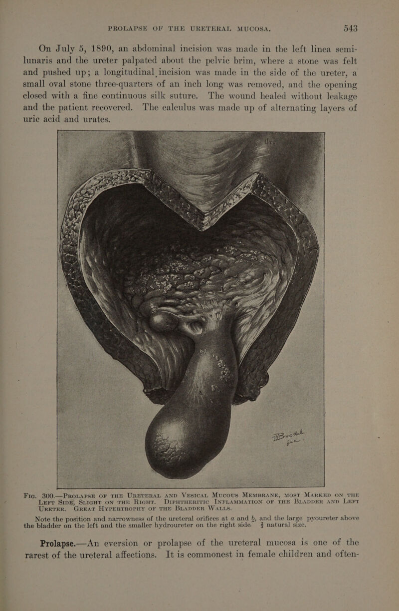 On July 5, 1890, an abdominal incision was made in the left linea semi- lunaris and the ureter palpated about the pelvic brim, where a stone was felt and pushed up; a longitudinal incision was made in the side of the ureter, a small oval stone three-quarters of an inch long was removed, and the opening closed with a fine continuous silk suture. The wound healed without leakage and the patient recovered. The calculus was made up of alternating layers of uric acid and urates. | Fig. 300.—PROLAPSE OF THE URETERAL AND VEsicAL Mucous MEMBRANE, MOST MARKED ON THE Lert SpE, SLIGHT ON THE RicHT. DiIPHTHERITIC INFLAMMATION OF THE BLADDER AND LEFT URETER. GREAT HYPERTROPHY OF THE BLADDER WALLS. Note the position and narrowness of the ureteral orifices at a and 8, and the large pyoureter above the bladder on the left and the smaller hydroureter on the right side. 4 natural size. Prolapse—An eversion or prolapse of the ureteral mucosa is one of the rarest of the ureteral affections. It is commonest in female children and often-