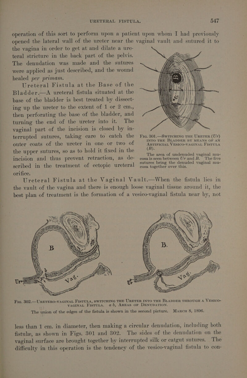 operation of this sort to perform upon a patient upon whom I had previously opened the lateral wall of the ureter near the vaginal vault and sutured it to the vagina in order to get at and dilate a ure- teral stricture in the back part of the pelvis. The denudation was made and the sutures were applied as just described, and the wound healed per primam. Ureteral Fistula at the Base of the Bladder.—A ureteral fistula situated at the base of the bladder is best treated by dissect- ing up the ureter to the extent of 1 or 2 cm., then perforating the base of the bladder, and turning the end of the ureter into it. The vaginal part of the incision is closed by in- terrupted sutures, taking care to catch the Fic. 301.—Swrremne rae Urerer (Ur) Pec aiectatheisoter anetmcuonsiwo Of) aacaainvamonvaomar Froecce the upper sutures, so as to hold it fixed in the att Bae Rar, ‘ The area of undenuded vaginal mu- incision and thus prevent retraction, as de- cosaisseen between Ur and B. The five scribed in the treatment of ectopic ureteral Sega seo: ena ma orifice. Ureteral Fistula at the Vaginal Vault.—When the fistula lies in the vault of the vagina and there is enough loose vaginal tissue around it, the best plan of treatment is the formation of a vesico-vaginal fistula near by, not SAS INS 4 3 Se : a ath Loe &amp; OR ia : LES Yi )y Je SSS Ur &lt;&lt; a Lee Fic. 302.—URETERO-VAGINAL FISTULA, SWITCHING THE URETER INTO THE BLADDER THROUGH A VESICO- VAGINAL FistuLa. ab, AREAS OF DENUDATION. The union of the edges of the fistula is shown in the second picture. Marcu 8, 1896. less than 1 cm. in diameter, then making a circular denudation, including both fistule, as shown in Figs. 301 and 302. The sides of the denudation on the vaginal surface are brought together by interrupted silk or catgut sutures. The difficulty in this operation is the tendency of the vesico-vaginal fistula to con-