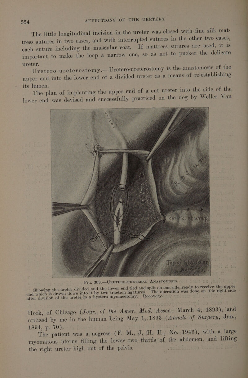The little longitudinal incision in the ureter was closed with fine silk mat- tress sutures in two cases, and with interrupted sutures in the other two cases, each suture including the muscular coat. If mattress sutures are used, it is important to make the loop a narrow one, So as not to pucker the delicate ureter. | Uretero-ureterostomy.—Uretero-ureterostomy is the anastomosis of the upper end into the lower end of a divided ureter as a means of re-establishing its lumen. | 7 The plan of implanting the upper end of a cut ureter into the side of the lower end was devised and successfully practiced on the dog by Weller Van Pig. 303.—URETERO-URETERAL ANASTOMOSIS. © | tos folin«es Showing the. ureter divided and the lower end tied and split on one side, ready to receive: the upper end which is drawn down into it by two traction ligatures. The operation was done on the right side after division of the ureter in a hystero-myomectomy. Recovery na77 “i6o) 9507 5 eiitr Hook, of Chicago (Jour. of the Amer. Med. Assoc., March 4, 1893), and utilized by me in the human being May 1,.1893 (Annals of Surgery, Jan., 1894, p. 70). sod 6. . , eovln: Paiag er The patient was a negress (F. M., J. H. H.,; No. 1946), with a, large myomatous uterus filling the lower two thirds of the abdomen, and lifting the right ureter high out of the pelvis. : 5) eigen ttt