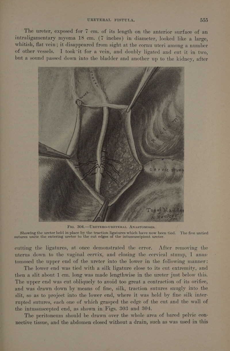 The ureter, exposed for 7 cm. of its length on the anterior surface of an intraligamentary myoma 18 cm. (7 inches) in diameter, looked like a large, whitish, flat vein; it disappeared from sight at the cornu uteri among a number of other vessels. I took ‘it for a vein, and doubly ligated and cut it in two, but a sound passed down into the bladder and another up to the kidney, after Showing the ureter held in place by the traction ligatures which have now been tied. The five untied sutures unite the entering ureter to the cut edges of the intussuscipient ureter. — cutting the ligatures, at once demonstrated the error. After removing the uterus down to the vaginal cervix, and closing the cervical stump, I anas- tomosed the upper end of the ureter into the lower in the following manner: The lower end was tied with a silk ligature close to its cut extremity, and then a slit about 1 cm. long was made lengthwise in the ureter just below this. The upper end was cut obliquely to avoid too great.a contraction of its orifice, and was drawn down by means of fine, silk, traction sutures snugly into the slit, so as to project into the lower end, where it was held by fine silk inter- rupted sutures, each one of which grasped the edge of the cut and the wall of the intussuscepted end, as shown in Figs. 303 and 304. The peritoneum should be drawn over the whole area of bared pelvic con- nective tissue, and the abdomen closed without a drain, such as was used in this