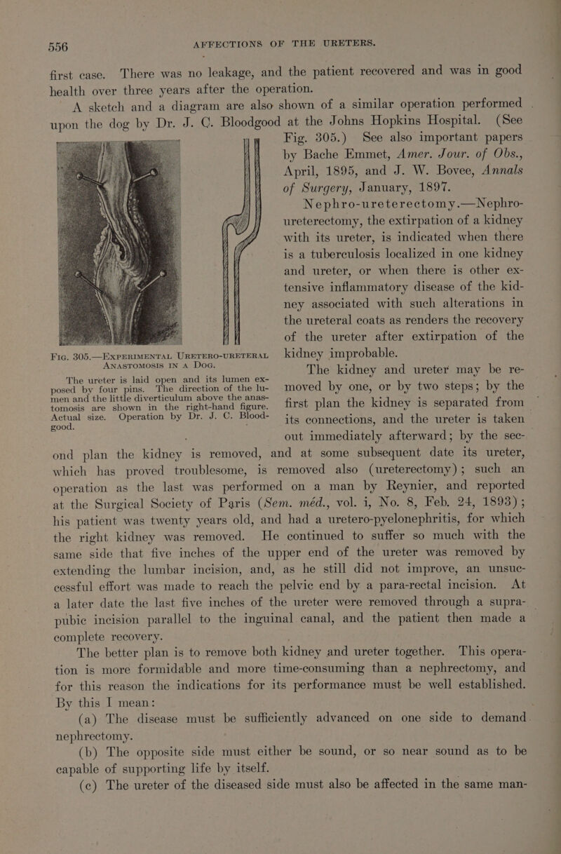 first case. There was no leakage, and the patient recovered and was in good health over three years after the operation. A sketch and a ca are also shown of a similar operation performed upon the dog by Dr. J. ©. nes at the Johns Hopkins Hospital. (See Fig. 305.) See also important papers by Bache Emmet, Amer. Jour. of Obs., April, 1895, and J. W. Bovee, Annals of Surgery, January, 1897. Nephro-ureterectomy.—Nephro- ureterectomy, the extirpation of a kidney with its ureter, is indicated when there is a tuberculosis localized in one kidney and ureter, or when there is other ex- tensive inflammatory disease of the kid- ney associated with such alterations in the ureteral coats as renders the recovery ee el a AY of the ureter after extirpation of the Fig. 305.—ExPERIMENTAL URETERO-URETERAL kidney improbable. Balen Sin sesh cate The kidney and ureter may be re- The ureter is laid open and its lumen ex- posed by four pins. The direction of the lu- moved by one, or by two steps; by the men and the little diverticulum above the anas- . : , tomosis are shown in the right-hand figure. first plan the kidney 1S separated from eae size. Operation by Dr. J. ©. Blood- its eonnections, and the ureter is taken . out immediately afterward; by the sec- ond plan the kidney is removed, and at some subsequent date its ureter, which has proved troublesome, is removed also (ureterectomy); such an operation as the last was peter ee on a man by Reynier, and reported at the Surgical Society of Paris (Sem. méd., vol. i, No. 8, Feb. 24, 1893); his patient was twenty years old, and had a ae aelonennnine for which the right kidney was removed. He continued to suffer so much with the same side that five inches of the upper end of the ureter was removed by extending the lumbar incision, and, as he still did not improve, an unsuc- cessful effort was made to reach the pelvic end by a para-rectal incision. At a later date the last five inches of the ureter were removed through a supra- pubic incision parallel to the inguinal canal, and the patient then made a complete recovery. The better plan is to remove both kidney and ureter together. This opera- tion is more formidable and more time-consuming than a nephrectomy, and for this reason the indications for its performance must be well established. By this I mean: ea?) (a) The disease must be sufficiently advanced on one side to demand. nephrectomy. | (b) The opposite side must either be sound, or so near sound as to be capable of supporting life by itself. (c) The ureter of the diseased side must also be affected in the same man-