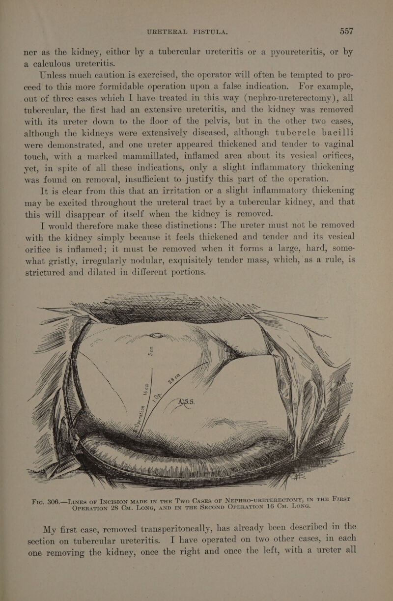 ner as the kidney, either by a tubercular ureteritis or a pyoureteritis, or by a calculous ureteritis. Unless much caution is exercised, the operator will often be tempted to pro- ceed to this more formidable operation upon a false indication. For example, out of three cases which I have treated in this way (nephro-ureterectomy ), all tubercular, the first had an extensive ureteritis, and the kidney was removed with its ureter down to the floor of the pelvis, but in the other two eases, although the kidneys were extensively diseased, although tubercle bacilli were demonstrated, and one ureter appeared thickened and tender to vaginal touch, with a’ marked mammillated, inflamed area about its vesical orifices, yet, in spite of all these indications, only a slight inflammatory thickening was found on removal, insufficient to justify this part of the operation. It is clear from this that an irritation or a slight inflammatory thickening may be excited throughout the ureteral tract by a tubercular kidney, and that this will disappear of itself when the kidney is removed. I would therefore make these distinctions: The ureter must not be removed with the kidney simply because it feels thickened and tender and its vesical orifice is inflamed; it must be removed when it forms a large, hard, some- what gristly, irregularly nodular, exquisitely tender mass, which, as a rule, is strictured and dilated in different portions. Fic. 306.—Lines or INCISION MADE IN THE Two CAsES OF NEPHRO-URETERECTOMY, IN THE FuRsT OPERATION 28 Cm. LONG, AND IN THE SECOND OPERATION 16 Cm. LONG. My first case, removed transperitoneally, has already been described in the section on tubercular ureteritis. I have operated on two other cases, in each one removing the kidney, once the right and once the left, with a ureter all