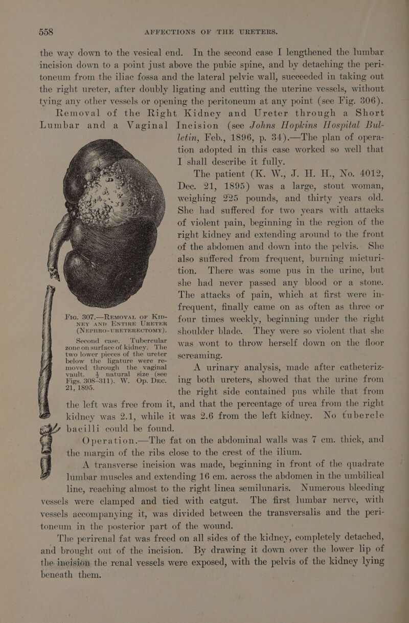 the way down to the vesical end. In the second case I lengthened the lumbar incision down to a point just above the pubic spine, and by detaching the peri- toneum from the iliac fossa and the lateral pelvic wall, succeeded in taking out the right ureter, after doubly ligating and cutting the uterine vessels, without tying any other vessels or opening the peritoneum at any point (see Fig. 306). Removal of the Right Kidney and Ureter through a Short Lumbar and a Vaginal Incision (see Johns Hopkins [Hostal Bul- letin, Feb., 1896, p. 34).—The plan of opera- tion adopted in this case worked so well that I shall describe it fully. The. patient (CK. W.; J. H.:H., No.-4012, Dec. 21, 1895) was a large, stout woman, weighing 225 pounds, and thirty years old. She had suffered for two years with attacks of violent pain, beginning in the region of the right kidney and extending around to the front of the abdomen and down into the pelvis.. She also suffered from frequent, burning micturi- tion. There was some pus in the urine, but she had never passed any blood or a stone. The attacks of pain, which at first were in- frequent, finally came on as often as three or Hie. 307.-Removat or Kip four times weekly, beginning under the right (Nepuro-ureTeREctoMY). shoulder blade. They were so violent that she A a payee was wont to throw herself down on the floor two lower pieces of the ureter sereaming. below the ligature were re- 5 2  moved through the vaginal A urinary analysis, made after catheteriz- vault. 4 natural size (see. ] Figs. 308-311). W. Op. Dxc. ing both ureters, showed that the urine from mee the right side contained pus while that from the left was free from it, and that the percentage of urea from the right kidney was 2.1, while it was 2.6 from the left kidney. No tubercle bacilli could be found. O peration.—The fat on the abdominal walls was 7 cm. thick, and the margin of the ribs close to the crest of the ilium. __ A transverse incision was made, beginning in front of the quadrate lumbar muscles and extending 16 em. across the abdomen in the umbilical line, reaching almost to the right linea semilunaris. Numerous bleeding vessels were clamped and tied with catgut. The first lumbar nerve, with vessels accompanying it, was divided between the transversalis and the peri- toneum in the posterior part of the wound. The perirenal fat was freed on all sides of the kidney, completely detached, and brought out of the incision. By drawing it down over the lower lip of the incision the renal vessels were exposed, with the pelvis of the kidney lying beneath them.