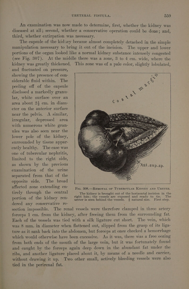 An examination was now made to determine, first, whether the kidney was diseased at all; second, whether a conservative operation could be done; and, third, whether extirpation was necessary. The capsule of the kidney became almost completely detached in the simple manipulation necessary to bring it out of the incision. The upper and lower portions of the organ looked like a normal kidney substance intensely congested (see Fig. 807). At the middle there was a zone, 3 to 4 em. wide, where the kidney was greatly thickened. This zone was of a pale color, slightly lobulated, ~ and fluctuated on pressure, showing the presence of con- siderable fluid within. The peeling off of the capsule disclosed a markedly granu- lar, white surface over an area about 24 em. in diam- eter on the anterior surface near the pelvis. A similar, irregular, depressed area with numerous white gran- ules was also seen near the lower pole of the kidney, surrounded by tissue appar- ently healthy. The case was one of tubercular nephritis, limited. to the right side, as shown by the previous examination of the urine separated from that of the opposite side. The broad affected zone extending en- [ Fig. 308.—REMOVAL OF TUBERCULAR KIDNEY AND URETER. tirely through the central The kidney is brought out of the horizontal incision in the : me r right loin; the vessels are exposed and ready to tie. The portion of the kidney ren ureter is seen behind the vessels. # natural size. First step. dered any conservative re- ; section impossible. The renal vessels were therefore clamped in three artery forceps 1 cm. from the kidney, after freeing them from the surrounding fat. Each of the vessels was tied with a silk ligature cut short. The vein, which was 8 mm. in diameter when flattened out, slipped from the grasp of its liga- ture as it sank back into the abdomen, but forceps at once checked a hemorrhage which would otherwise have been excessive. As it was, there was a free oozing from both ends of the mouth of the large vein, but it was fortunately found and caught by the forceps again deep down in the abundant fat under the ribs, and another ligature placed. about it, by means of a needle and carrier, without drawing it up. Two other small, actively bleeding vessels were also tied in the perirenal fat.