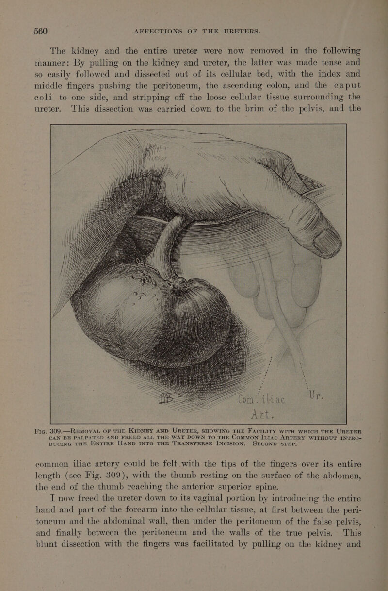 The kidney and the entire ureter were now removed in the following manner: By pulling on the kidney and ureter, the latter was made tense and so easily followed and dissected out of its cellular bed, with the index and middle fingers pushing the peritoneum, the ascending colon, and the caput coli to one side, and stripping off the loose cellular tissue surrounding the ureter. This dissection was carried down to the brim of the pelvis, and the Fic. 309.—REMOVAL OF THE KIDNEY AND URETER, SHOWING THE FACILITY WITH WHICH THE URETER CAN BE PALPATED AND FREED ALL THE WAY DOWN TO THE CoMMON ILIAC ARTERY WITHOUT INTRO- DUCING THE ENTIRE HAND INTO THE TRANSVERSE INCISION. SECOND STEP. common iliac artery could be felt with the tips of the fingers over its entire length (see Fig. 809), with the thumb resting on the surface of the abdomen, the end of the thumb reaching the anterior superior spine. I now freed the ureter down to its vaginal portion by introducing the entire hand and part of the forearm into the cellular tissue, at first between the peri- toneum and the abdominal wall, then under the peritoneum of the false pelvis, and finally between the peritoneum and the walls of the true pelvis. This blunt dissection with the fingers was facilitated by pulling on the kidney and