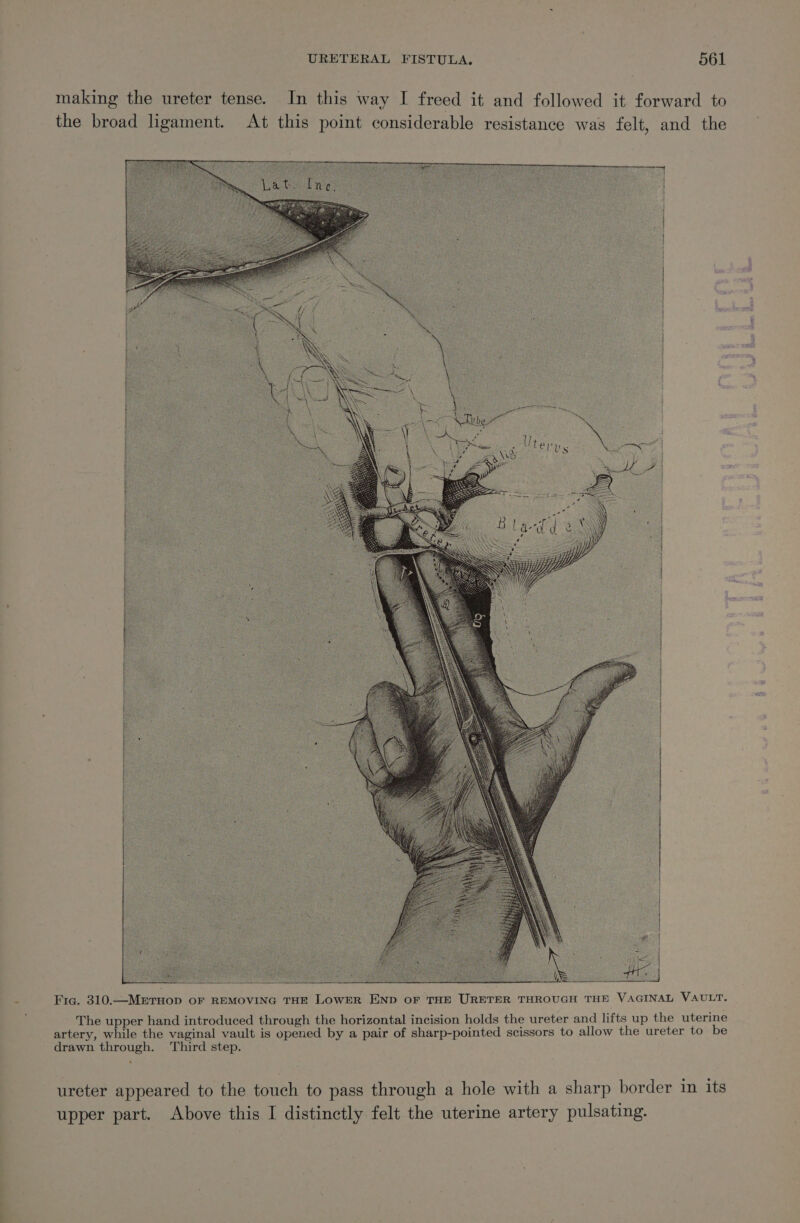 making the ureter tense. In this way I freed it and followed it forward to the broad ligament. At this point considerable resistance was felt, and the Fre. 310.—METHOD OF REMOVING THE LOWER END OF THE URETER THROUGH THE VAGINAL VAULT. The upper hand introduced through the horizontal incision holds the ureter and lifts up the uterine artery, while the vaginal vault is opened by a pair of sharp-pointed scissors to allow the ureter to be drawn through. Third step. . ureter appeared to the touch to pass through a hole with a sharp border in its upper part. Above this I distinctly felt the uterine artery pulsating.