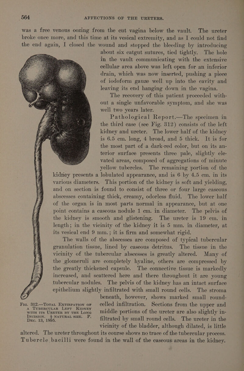 was a free venous oozing from the cut vagina below the vault. The ureter broke once more, and this time at its vesical extremity, and as I could not find the end again, I closed the wound and stopped the bleeding by introducing about six catgut sutures, tied tightly. The hole in the vault communicating with the extensive cellular area above was left open for an inferior drain, which was now inserted, pushing a piece of iodoform gauze well up into the cavity and leaving its end hanging down in the vagina. The recovery of this patient proceeded with- out a single unfavorable symptom, and she was well two years later. Pathological Report.—The specimen in the third case (see Fig. 812) consists of the left kidney and ureter. The lower half of the kidney is 6.5 cm. long, 4 broad, and 5 thick. It is for the most part of a dark-red color, but on its an- terior surface presents three pale, slightly ele- vated areas, composed of aggregations of minute yellow tubercles. The remaining portion of the kidney presents a lobulated appearance, and is 6 by 4.5 em. in its various diameters. This portion of the kidney is soft and yielding, and on section is found to consist of three or four large caseous abscesses containing thick, creamy, odorless fluid. The lower half of the organ is in most parts normal in appearance, but at one point contains a caseous nodule 1 em. in diameter. The pelvis of , the kidney is smooth and glistening. The ureter is 19 em. in v length; in the vicinity of the kidney it is 5 mm. in diameter, at ‘ its vesical end 9 mm.; it is firm and somewhat rigid. | The walls of the abscesses are composed of typical tubercular eranulation tissue, lined by caseous detritus. The tissue in the vicinity of the tubercular abscesses is greatly altered. Many of the glomeruli are completely hyaline, others are compressed by the greatly thickened capsule. The connective tissue is markedly increased, and scattered here and there throughout it are young tubercular nodules. The pelvis of the kidney has an intact surface epithelium slightly infiltrated with small round cells. The stroma beneath, however, shows marked small round- Fig. 312.—Tora Exrmpation or celled infiltration. Sections from the upper and iis ane Date TE Lowes aL ee portions of the ureter are also slightly in- Dee een ees sue. P. filtrated by small round cells. The ureter in the vicinity of the bladder, although dilated, is little altered. The ureter throughout its course shows no trace of the tubercular process. Tubercle bacilli were found in the wall of the caseous areas in the kidney.