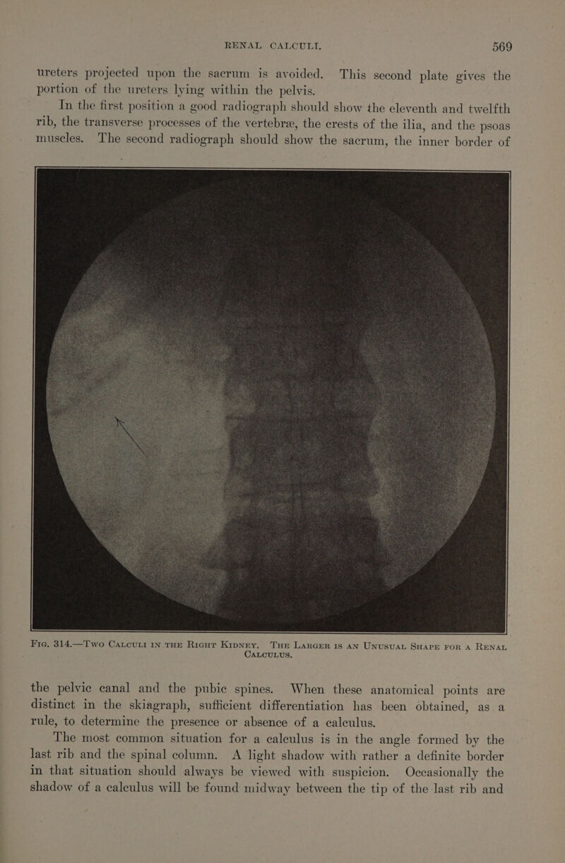 ureters projected upon the sacrum is avoided. This second plate gives the portion of the ureters lying within the pelvis. In the first position a good radiograph should show the eleventh and twelfth rib, the transverse processes of the vertebrae, the crests of the ilia, and the psoas muscles. The second radiograph should show the sacrum, the inner border of the pelvic canal and the pubic spines. When these anatomical points are distinct in the skiagraph, sufficient differentiation has been obtained, as a rule, to determine the presence or absence of a calculus. The most common situation for a calculus is in the angle formed by the last rib and the spinal column. A light shadow with rather a definite border in that situation should always be viewed with suspicion. Occasionally the shadow of a calculus will be found midway between the tip of the last rib and