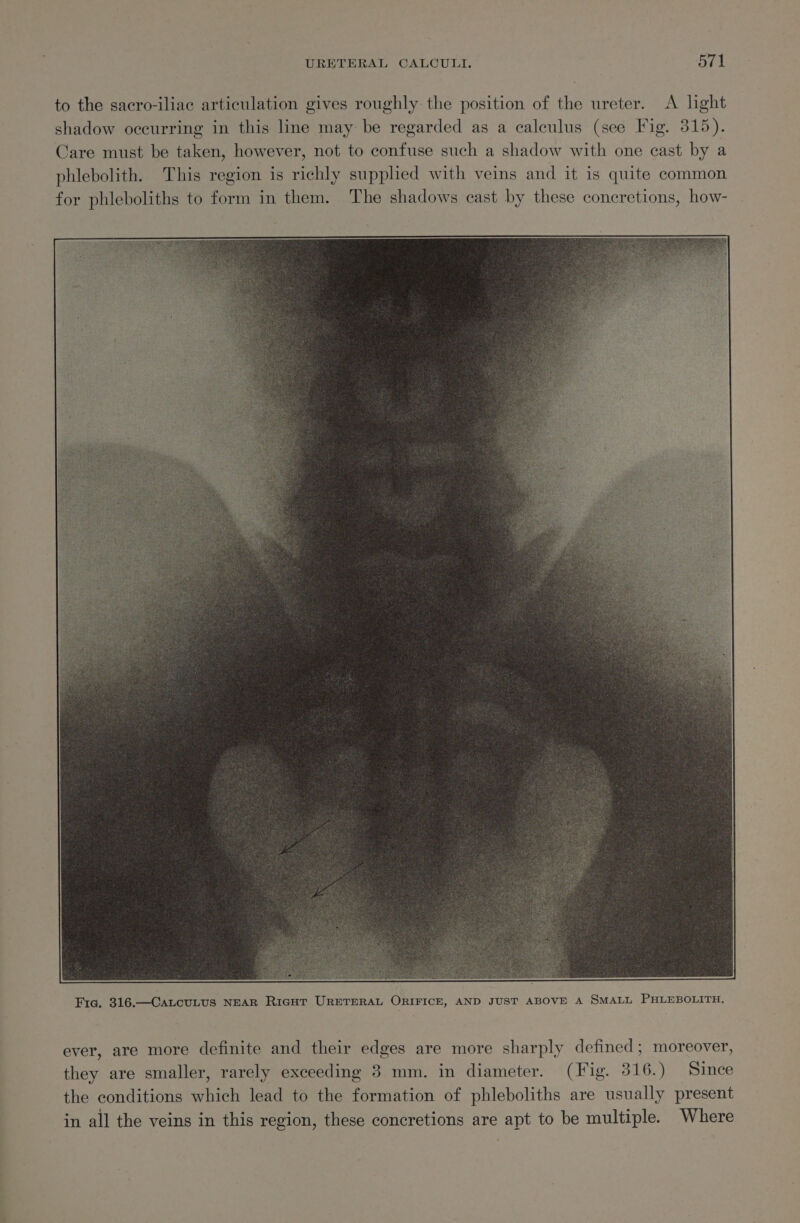 to the sacro-iliac articulation gives roughly the position of the ureter. A lght shadow occurring in this line may be regarded as a calculus (see Fig. 315). Care must be taken, however, not to confuse such a shadow with one cast by a phlebolith. This region is richly supplied with veins and it is quite common for phleboliths to form in them. The shadows cast by these concretions, how- ever, are more definite and their edges are more sharply defined; moreover, they are smaller, rarely exceeding 3 mm. in diameter. (Fig. 316.) Since the conditions which lead to the formation of phleboliths are usually present in all the veins in this region, these concretions are apt to be multiple. Where