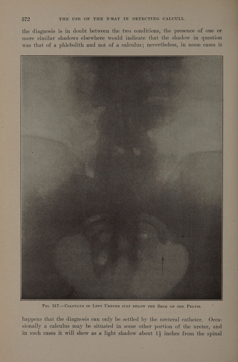 the diagnosis is in doubt between the two conditions, the presence of one or more similar shadows elsewhere would indicate that the shadow in question was that of a phlebolith and not of a calculus; nevertheless, in some cases 1t happens that the diagnosis can only be settled by the ureteral catheter. -Ocea- sionally a calculus may be situated in some other portion of the ureter, and in such cases it will show as a light shadow about 14 inches from the spinal