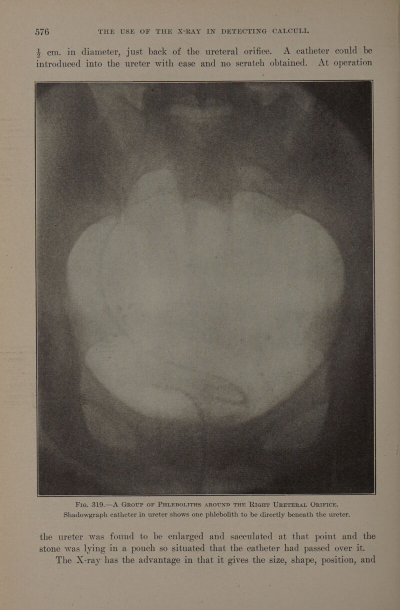 4 em. in diameter, just back of the ureteral orifice. A catheter could be “= introduced into the ureter with ease and no scratch obtained. At operation Shadowgraph catheter in ureter shows one phlebolith to be directly beneath the ureter. the ureter was found to be enlarged and sacculated at that point and the stone was lying in a pouch so situated that the catheter had passed over it. The X-ray has the advantage in that it gives the size, shape, position, and a