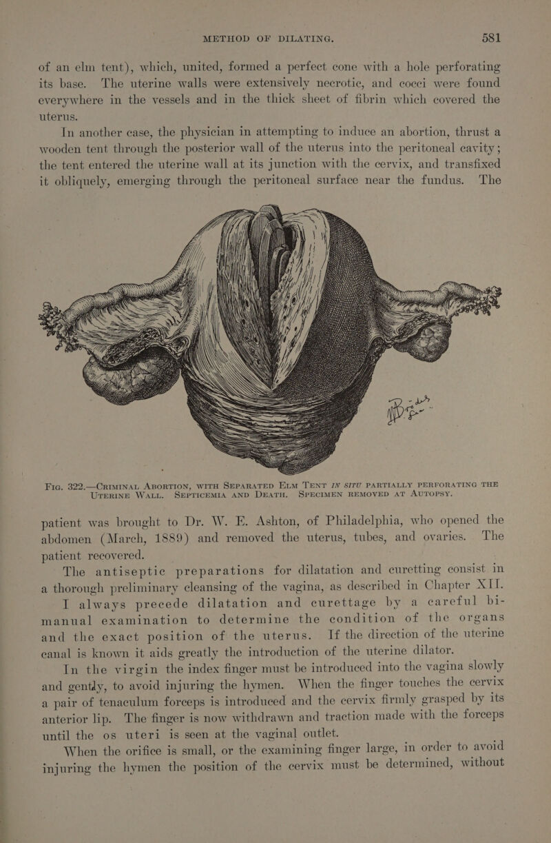 of an elm tent), which, united, formed a perfect cone with a hole perforating its base. The uterine walls were extensively necrotic, and cocci were found everywhere in the vessels and in the thick sheet of fibrin which covered the uterus. ) In another case, the physician in attempting to induce an abortion, thrust a wooden tent through the posterior wall of the uterus into the peritoneal cavity 5 the tent entered the uterine wall at its junction with the cervix, and transfixed it obliquely, emerging through the peritoneal surface near the fundus. The patient was brought to Dr. W. E. Ashton, of Philadelphia, who opened the abdomen (March, 1889) and removed the uterus, tubes, and ovaries. The patient recovered. The antiseptic preparations for dilatation and curetting consist im a thorough preliminary cleansing of the vagina, as described in Chapter XII. I always precede dilatation and curettage by a eareful bi- manual examination to determine the condition of the organs and the exact position of the uterus. If the direction of the uterine canal is known it aids greatly the introduction of the uterine dilator. In the virgin the index finger must be introduced into the vagina slowly and gently, to avoid injuring the hymen. When the finger touches the cervix a pair of tenaculum forceps is introduced and the cervix firmly grasped by its anterior lip. The finger is now withdrawn and traction made with the forceps until the os uteri is seen at the vaginal outlet. When the orifice is small, or the examining finger large, in order to avoid injuring the hymen the position of the cervix must be determined, without