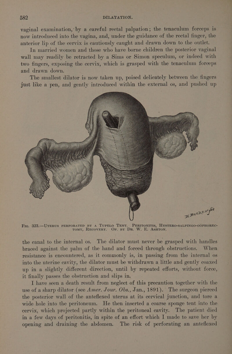 vaginal examination, by a careful rectal palpation; the tenaculum forceps is now introduced into the vagina, and, under the guidance of the rectal finger, the anterior lip of the cervix is Be usly caught and drawn down to the outlet. In married women and those who have borne children the posterior vaginal wall may readily be retracted by a Sims or Simon speculum, or indeed with two fingers, exposing the cervix, which is grasped with the tenaculum forceps and drawn down. The smallest dilator is now taken up, poised delicately between the fingers just like a pen, and gently introduced within the external os, and pushed up Pee Fig. 323.—UTERUS PERFORATED BY A TUPELO TENT. PERITONITIS, HYSTERO-SALPINGO-OOPHOREC- ToMY, RECOVERY. Op. By DR. W. E. ASHTON. the canal to the internal os. The dilator must never be grasped with handles braced against the palm of the hand and forced through obstructions. When resistance is encountered, as it commonly is, in passing from the internal os into the uterine cavity, the dilator must be withdrawn a little and gently coaxed up in a slightly different direction, until by repeated efforts, without force, it finally passes the obstruction and slips in. I have seen a death result from neglect of this precaution together with the use of a sharp dilator (see Amer. Jour. Obs., Jan., 1891). The surgeon pierced the posterior wall of the anteflexed uterus at its cervical junction, and tore a wide hole into the peritoneum. He then inserted a coarse sponge tent into the cervix, which projected partly within the peritoneal cavity. The patient died in a few days of peritonitis, in spite of an effort which I made to save her by opening and draining the abdomen. The risk of perforating an anteflexed