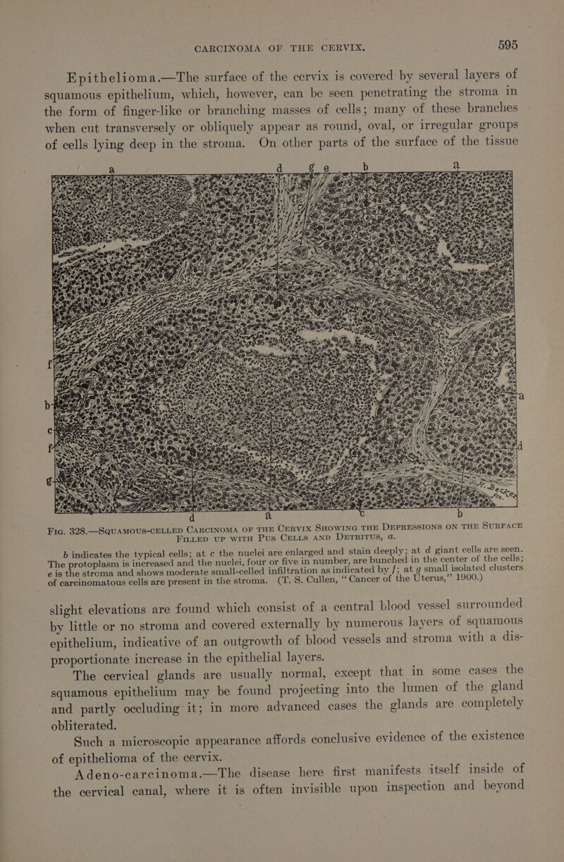 Epithelioma.—The surface of the cervix is covered by several layers of squamous epithelium, which, however, can be seen penetrating the stroma in the form of finger-like or branching masses of cells; many of these branches when cut transversely or obliquely appear as round, oval, or irregular groups of cells lying deep in the stroma. On other parts of the surface of the tissue b indicates the typical cells; at c the nuclei are enlarged and stain deeply; at d giant cells are seen. The protoplasm is increased and the nuclei, four or five in number, are bunched in the center of the cells; eis the stroma and shows moderate small-celled infiltration as indicated by /; at g small isolated clusters of carcinomatous cells are present in the stroma. (T.5. Cullen, “Cancer of the Uterus,” 1900.) slight elevations are found which consist of a central blood vessel surrounded by little or no stroma and covered externally by numerous layers of squamous epithelium, indicative of an outgrowth of blood vessels and stroma with a dis- proportionate increase in the epithelial layers. The cervical glands are usually normal, except that in some cases the squamous epithelium may be found projecting into the lumen of the gland and partly occluding it; in more advanced cases the glands are completely obliterated. Such a microscopic appearance affords conclusive evidence of the existence of epithelioma of the cervix. Adeno-carcinoma.—The disease here first manifests itself inside of the cervical canal, where it is often invisible upon inspection and beyond