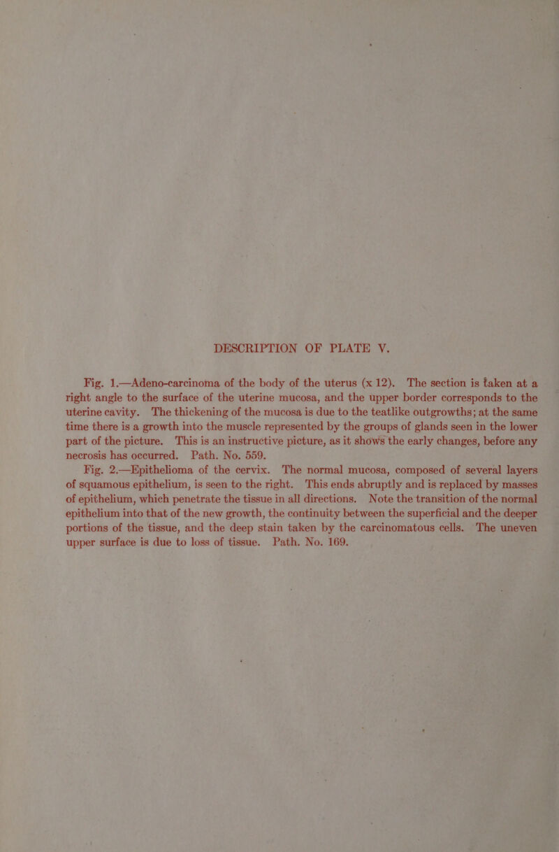 q : | : Ma iy, ms DESCRIPTION OF PLATE V. right angle to the surface of the uterine mucosa, and the upper border corresponds to uterine cavity. The thickening of the mucosa is due to the teatlike outgrowths; at t n time there is a growth into the muscle represented by the groups of glands seen in the lower | part of the picture. This is an instructive picture, as it shows the early ee before any necrosis has occurred. Path. No. 559. : Fig. 2.—Epithelioma of the cervix. The normal mucosa, PSs ies of squamous epithelium, is seen to the right. This ends abruptly and is replacec of NN which bees the tissue in all directions. Note the ea of th portions of pe iaine, eat the ep stad 5 en nt the carcinomatous cells. ¥ Th 2 ur upper surface is due to loss of tissue. Path. No. a : ‘ By