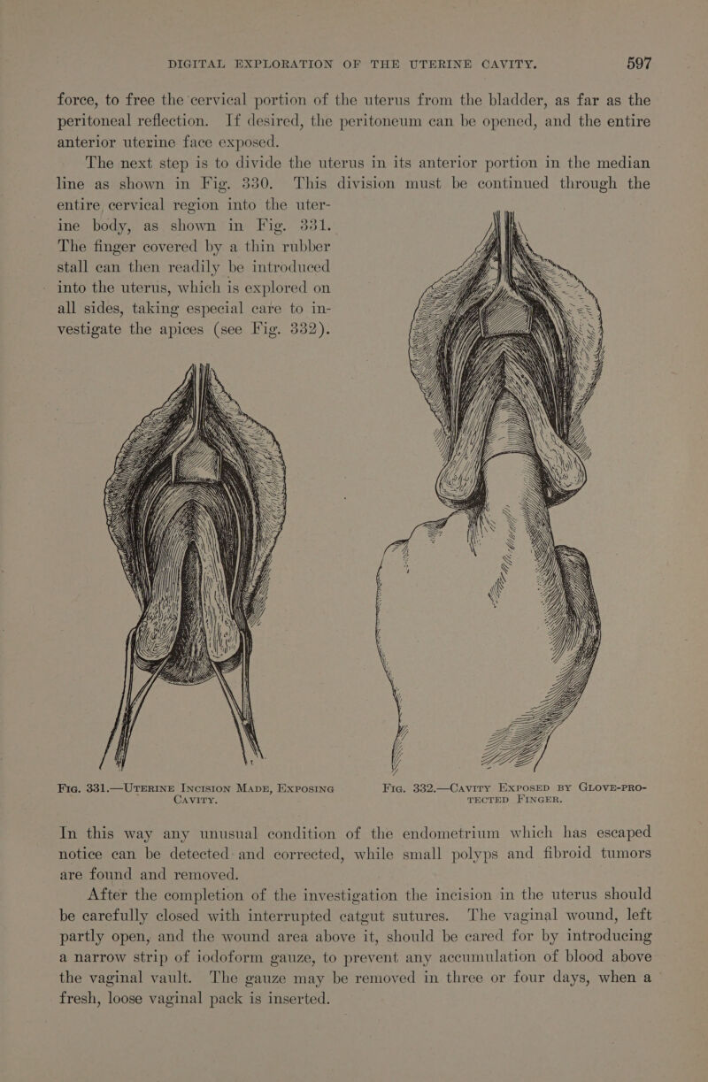 force, to free the cervical portion of the uterus from the bladder, as far as the peritoneal reflection. If desired, the peritoneum can be opened, and the entire anterior uterine face exposed. The next step is to divide the uterus in its anterior portion in the median line as shown in Fig. 330. This division must be continued through the entire, cervical region into the uter- ine body, as shown in Fig. 33 The finger covered by a thin rubber stall can then readily be introduced into the uterus, which is explored on all sides, taking especial care to in- vestigate the apices (see Fig. 332). “Lei ff i, Te Fig. 331.—UTERINE INcis1ion Mapn, Exposina Fig. 332.—Cavity ExposED BY GLOVE-PRO- Cavity. . TECTED FINGER. In this way any unusual condition of the endometrium which has escaped notice can be detected and corrected, while small polyps and fibroid tumors are found and removed. | After the completion of the investigation the incision in the uterus should be carefully closed with interrupted catgut sutures. The vaginal wound, left partly open, and the wound area above it, should be cared for by introducing a narrow strip of iodoform gauze, to prevent any accumulation of blood above the vaginal vault. The gauze may be removed in three or four days, when a fresh, loose vaginal pack is inserted.