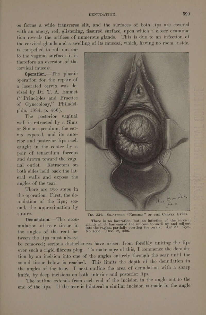 os forms a wide transverse slit, and the surfaces of both lips are covered with an angry, red, glistening, fissured surface, upon which a closer examina- tion reveals the orifices of numerous glands. This is due to an infection of the cervical. glands and a swelling of its mucosa, which, having no room inside, is compelled to roll out on- to the vaginal surface; it is therefore an eversion of the cervical mucosa. Operation.—The plastic operation for, the repair of a lacerated cervix was de- vised by Dr. T. A. Emmet (“ Principles and Practice of Gynecology,” Philadel- phia, 1884, p. 466). The posterior vaginal wall is retracted by a Sims or Simon speculum, the cer- vix exposed, and its ante- rior and posterior lips each caught in the center by a pair of tenaculum forceps and drawn toward the vagi- nal outlet. Retractors on: both sides hold back the lat- eral walls and expose the angles of the tear. There are two steps in the operation: First, the de- nudation of the lps; sec ond, the approximation by suture. Denudation.— The accu- There is no laceration, but an infection of ee cone , 1 j glands which has caused the mucosa to swell up and roll out mulation of scar tissue Im into the vagina, partially everting the cervix. Age 20. Gyn. the angles of the rent be- No. 4865. Dec. 12, 1896. tween the lips must always : be removed; serious disturbances have arisen from forcibly uniting the lips over such a rigid fibrous plug. To make sure of this, I commence the denuda- tion by an incision into one of the angles entirely through the sear until the sound tissue below is reached. This limits the depth of the denudation in the angles of the tear. I next outline the area of denudation with a sharp knife, by deep incisions on both anterior and posterior lips. The outline extends from each end of the incision in the angle out to the end of the lips. If the tear is bilateral a similar incision is made in the angle