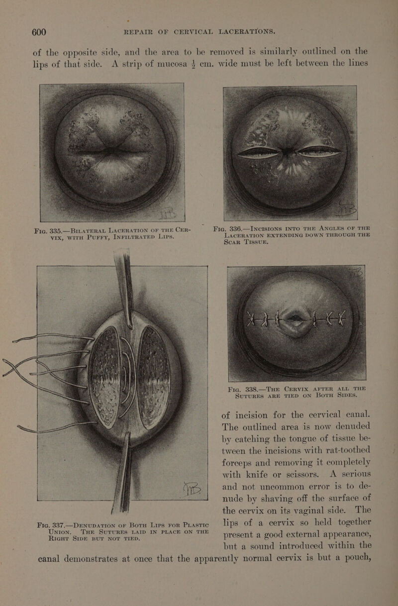 of the opposite side, and the area to be removed is similarly outlined on the lips of that side. A strip of mucosa $ em. wide must be left between the lines Fic. 335.—BILATERAL LACERATION OF THE CER- Fig. 336.—INCISIONS INTO THE ANGLES OF THE vIx, WITH Purry, INFILTRATED Lips. LACERATION EXTENDING DOWN THROUGH THE Scar TISSUE. of incision for the cervical canal. The outlined area is now denuded by catching the tongue of tissue be- tween the incisions with rat-toothed forceps and removing it completely with knife or scissors. A serious F and not uncommon error is to de-_ : nude by shaving off the surface of the cervix on its vaginal side. The Fic. 337.—DENUDATION oF Boru Lips FoR PLASTIC lips of a cervix so held together UNION. THE SuTURES LAID IN PLACE ON THE Ride San aaa ae present a good external appearance, but a sound introduced within the canal demonstrates at once that the apparently normal cervix is but a pouch,