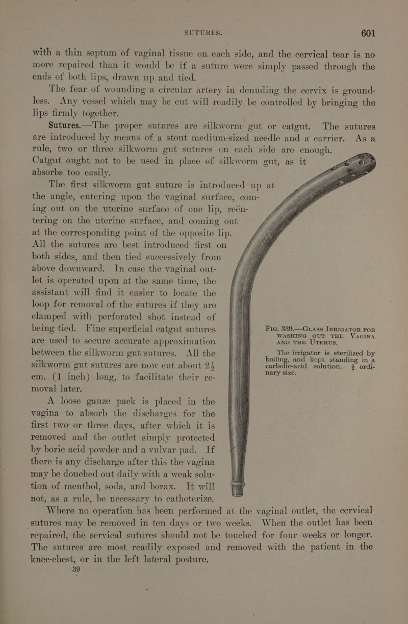 with a thin septum of vaginal tissue on each side, and the cervical tear is no more repaired than it would be if a suture were simply passed through the ends of both lips, drawn up and tied. The fear of wounding a cireular artery in denuding the cervix is ground- less. Any vessel which may be cut will readily be controlled by bringing the lips firmly together. Sutures.—T'he proper sutures are silkworm gut or catgut. The sutures are introduced by means of a stout medium-sized needle and a carrier. As a rule, two or three silkworm gut sutures on each side are enough. Catgut ought not to be used in place of silkworm gut, as it absorbs too easily. The first silkworm gut suture is introduced up at the angle, entering upon the vaginal surface, com- ing out on the uterine surface of one lip, reén- tering on the uterine surface, and coming out at the corresponding point of the opposite lip. All the sutures are best introduced first on both sides, and then tied successively from above downward. In case the vaginal out- let is operated upon at the same time, the assistant will find it easier to locate the loop for removal of the sutures if they are clamped with perforated shot instead of being tied. Fine superficial catgut sutures are used to secure accurate approximation between the silkworm gut sutures. All the silkworm gut sutures are now cut about 24 em. (1 inch) long, to facilitate their re- moval later. A loose gauze pack is placed in the vagina to absorb the discharges for the first two or three days, after which it is removed and the outlet simply protected by boric acid powder and a vulvar pad. If there is any discharge after this the vagina may be douched out daily with a weak solu- tion of menthol, soda, and borax. It will not, as a rule, be necessary to catheterize. Where no operation has been performed at the vaginal outlet, the cervical sutures may be removed in ten days or two weeks. When the outlet has been ‘repaired, the servical sutures should not be touched for four weeks or longer. The sutures are most readily exposed and removed with the patient in the knee-chest, or in the left lateral posture. 39 Fic. 339.—Guass IRRIGATOR FOR WASHING OUT THO VAGINA AND THE UTERUS. The irrigator is sterilized by boiling, and kept standing in a carbolic-acid solution. 4 ordi- nary size.