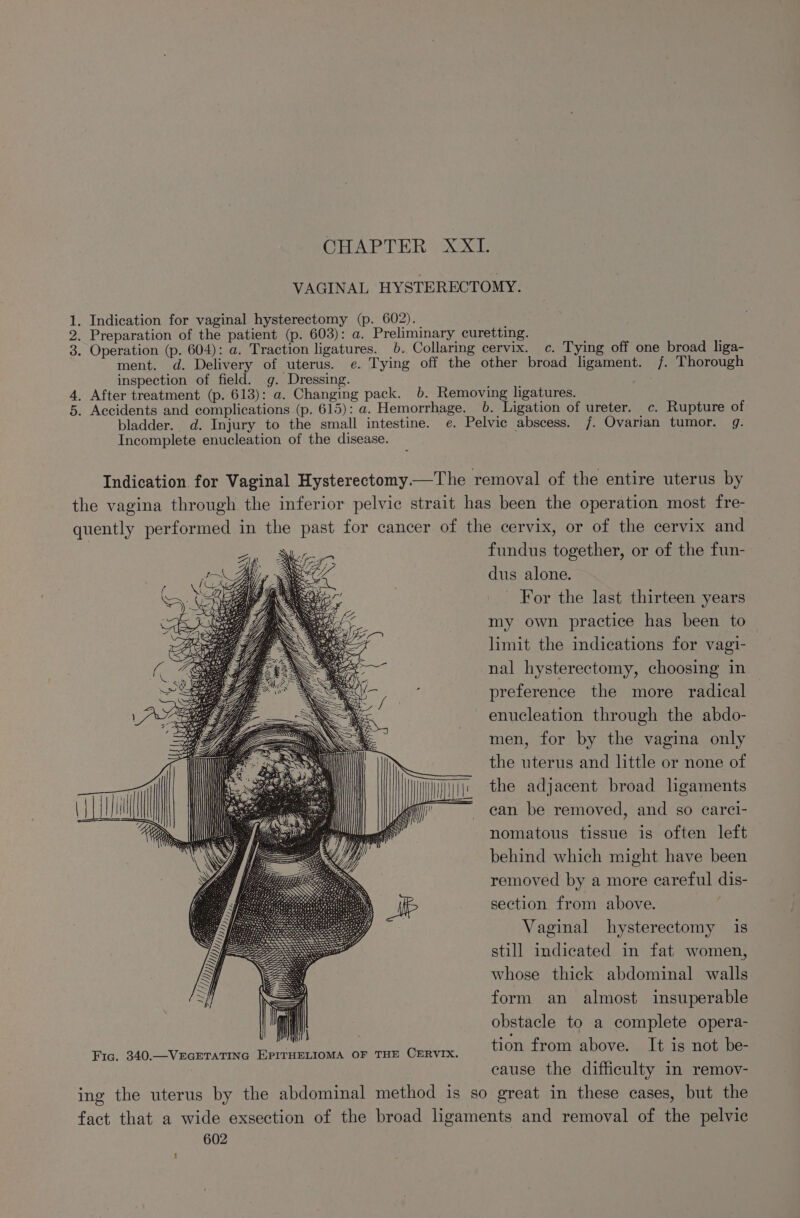 CHAPTER ) X21 VAGINAL HYSTERECTOMY. 1. Indication for vaginal hysterectomy (p. 602)._ ; 2. Preparation of the patient (p. 603): a. Preliminary curetting. 3. Operation (p. 604): a. Traction ligatures. b.. Collaring cervix. c. Tying off one broad liga- ment. d. Delivery of uterus. e. Tying off the other broad ligament. /. Thorough inspection of field. g. Dressing. Cees ie 4. After treatment (p. 613): a. Changing pack. 6. Removing ligatures. 5. Accidents and complications (p. 615): a2. Hemorrhage. 6. Ligation of ureter. c. Rupture of bladder. d. Injury to the small intestine. e. Pelvic abscess. 7. Ovarian tumor. g. Incomplete enucleation of the disease. Indication for Vaginal Hysterectomy. The removal of the entire uterus by the vagina through the inferior pelvic strait has been the operation most fre- quently performed in the past for cancer of the cervix, or of the cervix and fundus together, or of the fun- dus alone. - For the last thirteen years my own practice has been to limit the indications for vagi- nal hysterectomy, choosing in preference the more radical enucleation through the abdo- men, for by the vagina only the uterus and little or none of Wii the adjacent broad ligaments gif =. can be removed, and so carci- nomatous tissue is often left behind which might have been removed by a more careful dis- JE section from above. Vaginal hysterectomy is still indicated in fat women, whose thick abdominal walls = form an almost insuperable Wii | obstacle to a complete opera- Fic. 340.—VEGETATING EPITHELIOMA OF THE CERVIX. tion from above. It is not be- : cause the difficulty in remov- ing the uterus by the abdominal method is so great in these cases, but the fact that a wide exsection of the broad ligaments and removal of the pelvic 1 ral