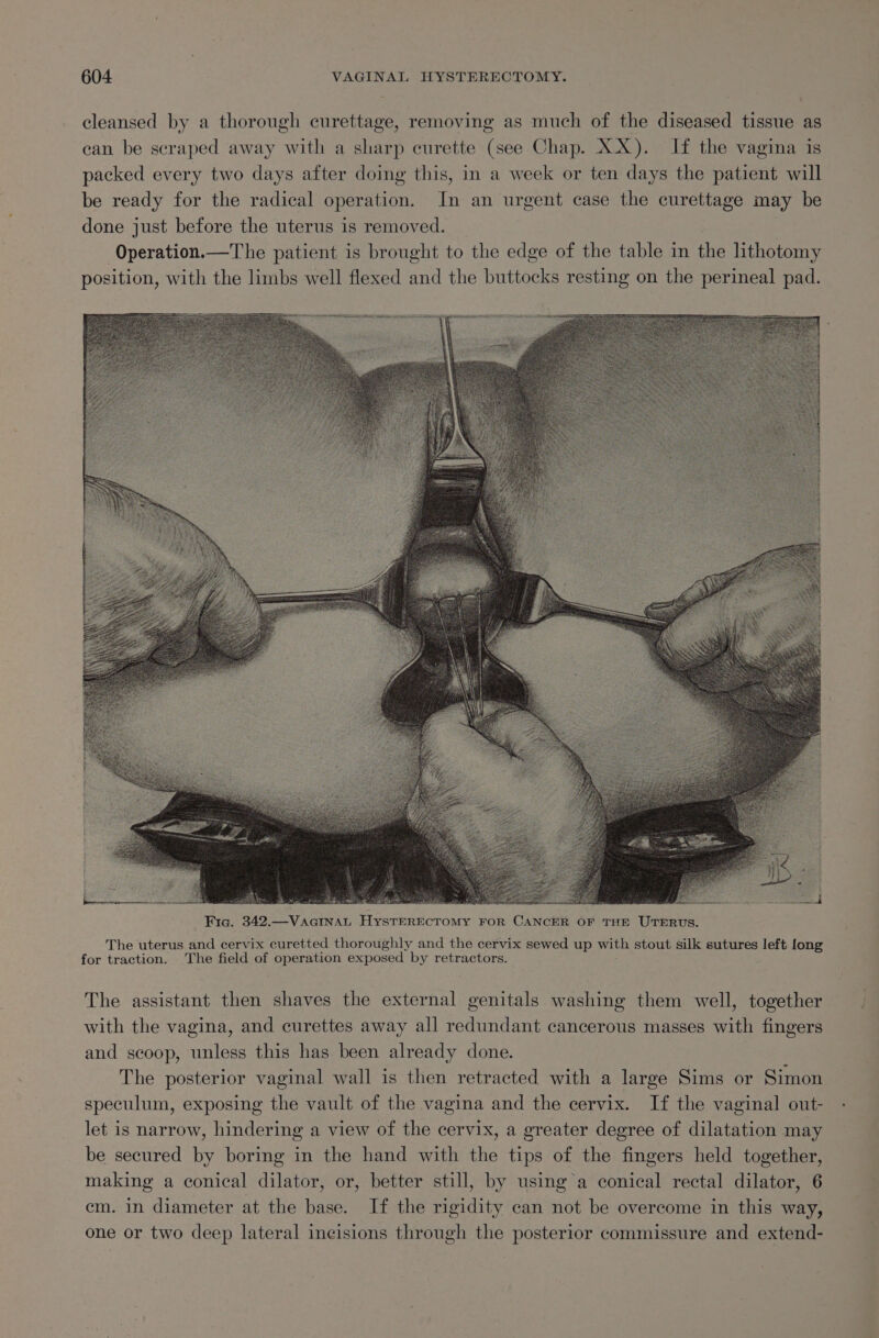 cleansed by a thorough curettage, removing as much of the diseased tissue as can be scraped away with a sharp curette (see Chap. XX). If the vagina is packed every two days after doing this, in a week or ten days the patient will be ready for the radical operation. In an urgent case the curettage may be done just before the uterus is removed. -Operation.—The patient is brought to the edge of the table in the lithotomy position, with the limbs well flexed and the buttocks resting on the perineal pad. The uterus and cervix curetted thoroughly and the cervix sewed up with stout silk sutures left long for traction. The field of operation exposed by retractors. The assistant then shaves the external genitals washing them well, together with the vagina, and curettes away all redundant cancerous masses with fingers and scoop, unless this has. been already done. The posterior vaginal wall is then retracted with a large Sims or Simon speculum, exposing the vault of the vagina and the cervix. If the vaginal out- let is narrow, hindering a view of the cervix, a greater degree of dilatation may be secured by boring in the hand with the tips of the fingers held together, making a conical dilator, or, better still, by using a conical rectal dilator, 6 cm. in diameter at the base. If the rigidity can not be overcome in this way, one or two deep lateral incisions through the posterior commissure and extend-