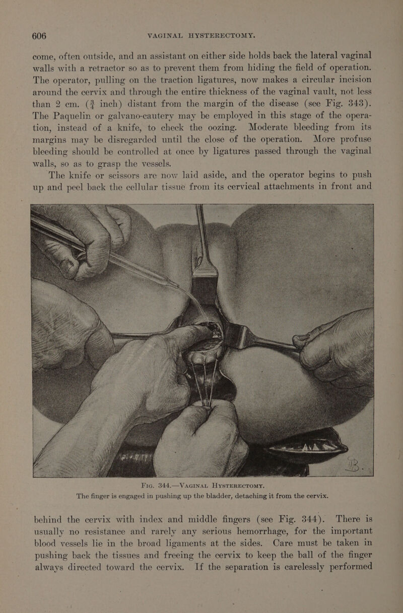 come, often outside, and an assistant on either side holds back the lateral vaginal walls with a retractor so as to prevent them from hiding the field of operation. The operator, pulling on the traction ligatures, now makes a circular incision around the cervix and through the entire thickness of the vaginal vault, not less than 2 em. (2 inch) distant from the margin of the disease (see Fig. 343). The Paquelin or galvano-cautery may be employed in this stage of the opera- tion, instead of a knife, to check the oozing. Moderate bleeding from its margins may be disregarded until the close of the operation. More profuse bleeding should be controlled at once by ligatures passed through the vaginal walls, so as to grasp the vessels. The knife or scissors are now laid aside, and the operator begins to push up and peel back the cellular tissue from its cervical attachments in front and The finger is engaged in pushing up the bladder, detaching it from the cervix. behind the cervix with index and middle fingers (see Fig. 344). There is usually no resistance and rarely any serious hemorrhage, for the important blood vessels lie in the broad ligaments at the sides. Care must be taken in pushing back the tissues and freeing the cervix to keep the ball of the finger always directed toward the cervix. If the separation is carelessly performed