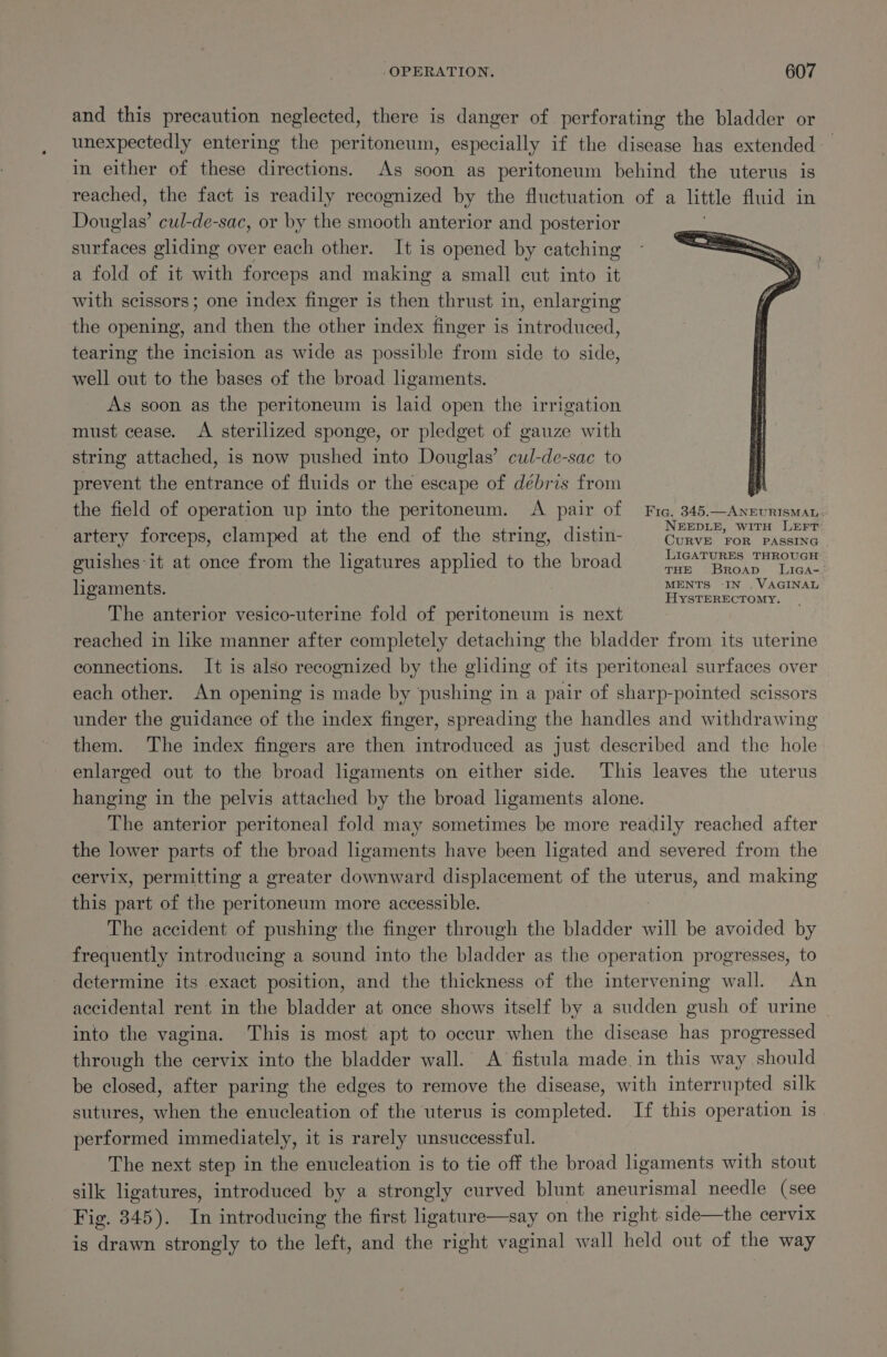 and this precaution neglected, there is danger of perforating the bladder or unexpectedly entering the peritoneum, especially if the disease has extended in either of these directions. As soon as peritoneum behind the uterus is reached, the fact is readily recognized by the fluctuation of a little fluid in okie cul-de-sac, or by the smooth anterior and posterior surfaces gliding over each other. It is opened by catching a fold of it with forceps and making a small cut into it with scissors; one index finger is then thrust in, enlarging the opening, and then the other index finger is introduced, tearing the incision as wide as possible from side to side, well out to the bases of the broad ligaments. As soon as the peritoneum is laid open the irrigation must cease. A sterilized sponge, or pledget of gauze with string attached, is now pushed into Douglas’ cul-de-sac to prevent the entrance of fluids or the escape of débris from the field of operation up into the peritoneum. A pair of Fic. 345.—Anevrisman NEEDLE, WITH LEFT artery forceps, clamped at the end of the string, distin- Convil ron, Hiseie . he : : LIGATURES THROUGH guishes:it at once from the lhgatures applied to the broad paar nS Pe ent ligaments MENTS -IN , VAGINAL Ss : HYSTERECTOMY. The anterior vesico-uterine fold of peritoneum is next reached in like manner after completely detaching the bladder from its uterine connections. It is also recognized by the gliding of its peritoneal surfaces over each other. An opening is made by pushing in a pair of sharp-pointed scissors under the guidance of the index finger, spreading the handles and withdrawing them. The index fingers are then introduced as just described and the hole enlarged out to the broad ligaments on either side. This leaves the uterus hanging in the pelvis attached by the broad ligaments alone. The anterior peritoneal fold may sometimes be more readily reached after the lower parts of the broad ligaments have been ligated and severed from the cervix, permitting a greater downward displacement of the uterus, and making this part of the peritoneum more accessible. The accident of pushing the finger through the Segeie will be avoided by frequently introducing a sound into the bladder as the operation progresses, to determine its exact position, and the thickness of the intervening wall. An accidental rent in the bladder at once shows itself by a sudden gush of urine | into the vagina. This is most apt to occur when the disease has progressed through the cervix into the bladder wall. A fistula made in this way should be closed, after paring the edges to remove the disease, with interrupted silk sutures, when the enucleation of the uterus is completed. If this operation 1s. performed immediately, it is rarely unsuccessful. The next step in the enucleation is to tie off the broad ligaments with stout silk ligatures, introduced by a strongly curved blunt Pcie i needle (see Fig. 345). In introducing the first ligature—say on the right side—the cervix is drawn strongly to the left, and the right vaginal wall held out of the way