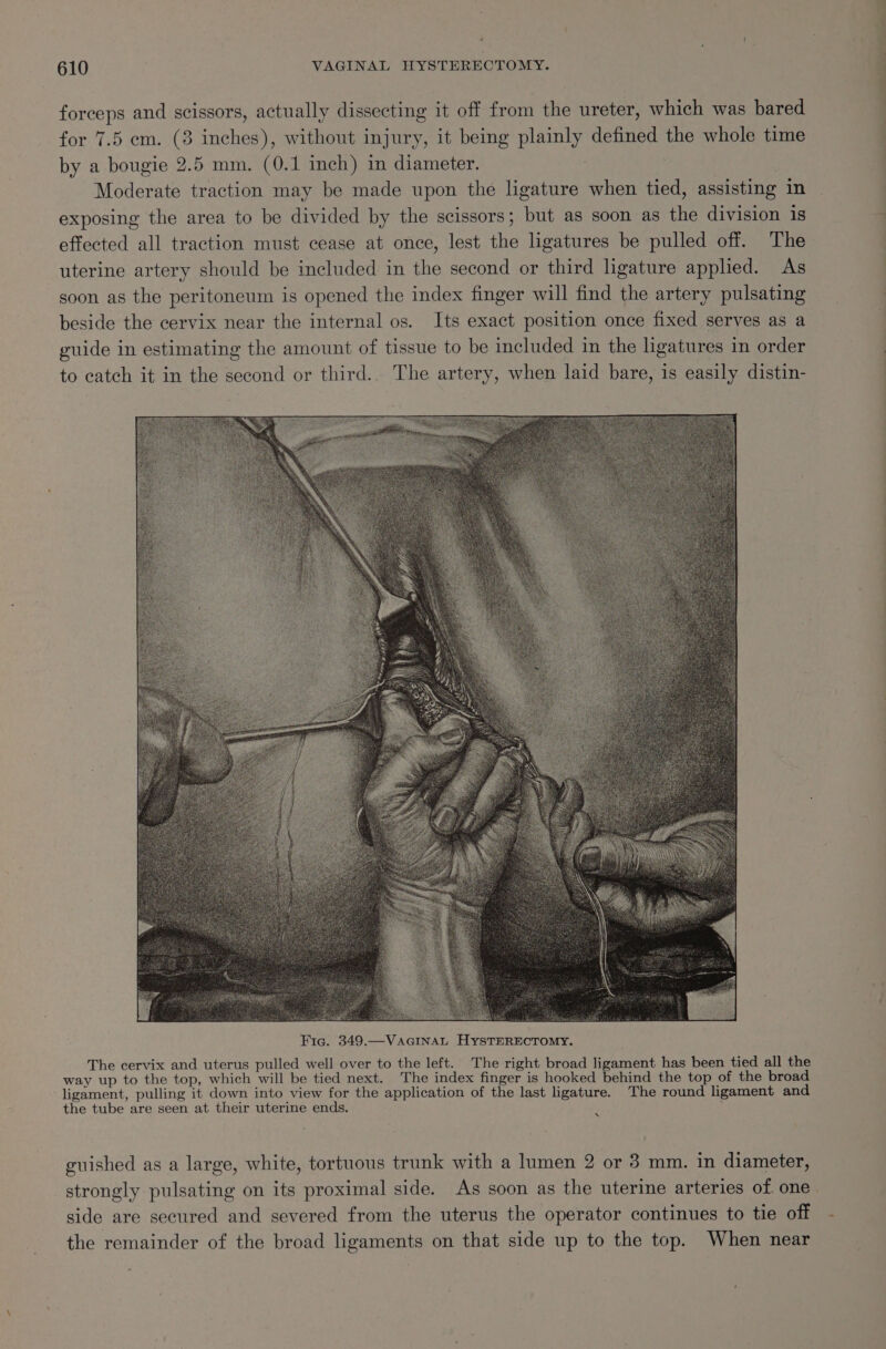 forceps and scissors, actually dissecting it off from the ureter, which was bared for 7.5 em. (3 inches), without injury, it being plainly defined the whole time by a bougie 2.5 mm. (0.1 inch) in diameter. | Moderate traction may be made upon the ligature when tied, assisting in exposing the area to be divided by the scissors; but as soon as the division 1s effected all traction must cease at once, lest the ligatures be pulled off. The uterine artery should be included in the second or third ligature applied. As soon as the peritoneum is opened the index finger will find the artery pulsating beside the cervix near the internal os. Its exact position once fixed serves as a guide in estimating the amount of tissue to be included in the ligatures in order to catch it in the second or third.. The artery, when laid bare, is easily distin- Fic. 349.—VAGINAL HYSTERECTOMY. The cervix and uterus pulled well over to the left.’ The right broad ligament has been tied all the way up to the top, which will be tied next. The index finger is hooked behind the top of the broad ligament, pulling it down into view for the application of the last ligature. The round ligament and the tube are seen at their uterine ends. mR, guished as a large, white, tortuous trunk with a lumen 2 or 3 mm. in diameter, side are secured and severed from the uterus the operator continues to tie off the remainder of the broad ligaments on that side up to the top. When near