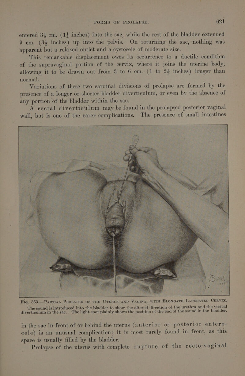 entered 34 em. (14 inches) into the sac, while the rest of the bladder extended 9 em. (34 inches) up into the pelvis. On returning the sac, nothing was apparent but a relaxed outlet and a cystocele of moderate size. This remarkable displacement owes its occurrence to a ductile condition _of the supravaginal portion of the cervix, where it joins the uterine body, allowing it to be drawn out from 3 to 6 cm. (1 to 23 inches) longer than normal. Variations of these two cardinal divisions of prolapse are formed by the presence of a longer or shorter bladder diverticulum, or even by the absence of any portion of the bladder within the sac. A rectal diverticulum may be found in the prolapsed posterior vaginal wall, but is one of the rarer complications. The presence of small intestines Fic. 353.—PartiaL PROLAPSE OF THE UTERUS AND VAGINA, wiTH ELonGaTE LAcERATED CERVIX. The sound is introduced into the bladder to show the altered direction of the urethra and the vesical diverticulum in the sac. The light spot plainly shows the position of the end of the sound in the bladder. in the sac in front of or behind the uterus (anterior or posterior entero- cele) ig an unusual complication; it is most rarely found in front, as this space is usually filled by the bladder. Prolapse of the uterus with complete rupture of the recto-vaginal