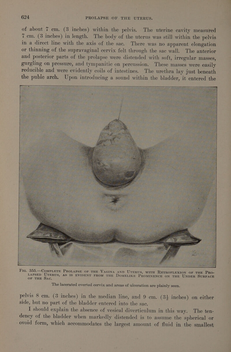 of about 7 em. (3 inches) within the pelvis. The uterine cavity measured 7 cm. (3 inches) in length. The body of the uterus was still within the pelvis in a direct line with the axis of the sac. There was no apparent elongation or thinning of the supravaginal cervix felt through the sac wall. The anterior and posterior parts of the prolapse were distended with soft, irregular masses, gurgling on pressure, and tympanitic on percussion. These masses were easily reducible and were evidently coils of intestines. The urethra lay just beneath the pubic arch. Upon introducing a sound within the bladder, it entered the The lacerated everted cervix and areas of ulceration are plainly seen. pelvis 8 em. (3 inches) in the median line, and 9 em. (34 inches) on either side, but no part of the bladder entered into the sac. I should explain the absence of vesical diverticulum in this way. The ten- dency of the bladder when markedly distended is to assume the spherical or -ovoid form, which accommodates the largest amount of fluid in the smallest