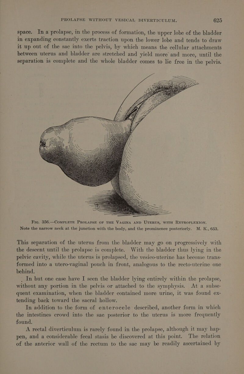 space. In a prolapse, in the process of formation, the upper lobe of the bladder in expanding constantly exerts traction upon the lower lobe and tends to draw it up out of the sac into the pelvis, by which means the cellular attachments between uterus and bladder are stretched and yield more’ and more, until the separation is complete and the whole bladder comes to lie free in the pelvis. a a, Ea NN \\ mA Fig. 356.—ComMPLETE PROLAPSE OF THE VAGINA AND UTERUS, WITH RETROFLEXION. Note the narrow neck at the junction with the body, and the prominence posteriorly. M. K., 653. This separation of the uterus from the bladder may go on progressively with the descent until the prolapse is complete. With the bladder thus lying in the pelvic cavity, while the uterus is prolapsed, the vesico-uterine has become trans- formed into a utero-vaginal pouch in front, analogous to the recto-uterine one behind. 3 _ In but one case have I seen the bladder lying entirely within the prolapse, without any portion in the pelvis or attached to the symphysis. At a subse- quent examination, when the bladder contained more urine, it was found ex- tending back toward the sacral hollow. In addition to the form of enterocele described, another form in which the intestines crowd into the sac posterior to the uterus is more frequently found. A rectal diverticulum is rarely found in the prolapse, although it may hap- pen, and a considerable fecal stasis be discovered at this point. The relation of the anterior wall of the rectum to the sac may be readily ascertained by