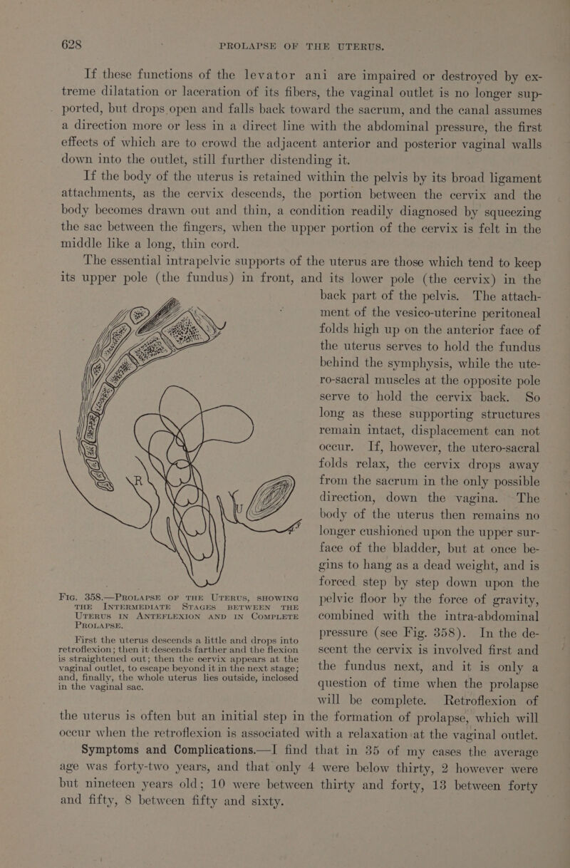 If these functions of the levator ani are impaired or destroyed by ex- treme dilatation or laceration of its fibers, the vaginal outlet is no longer sup- ported, but drops open and falls back toward the sacrum, and the canal assumes a direction more or less in a direct line with the abdominal pressure, the first effects of which are to crowd the adjacent anterior and posterior vaginal walls down into the outlet, still further distending it. If the body of the uterus is retained within the pelvis by its broad ligament attachments, as the cervix descends, the portion between the cervix and the body becomes drawn out and thin, a condition readily diagnosed by squeezing the sac between the fingers, when the upper portion of the cervix is felt in the middle like a long, thin cord. The essential intrapelvic supports of the uterus are those which tend to keep its upper pole (the fundus) in front, and its lower pole (the cervix) in the back part of the pelvis. The attach- ment of the vesico-uterine peritoneal folds high up on the anterior face of the uterus serves to hold the fundus behind the symphysis, while the ute- ro-sacral muscles at the opposite pole serve to hold the cervix back. So long as these supporting structures remain intact, displacement can not occur. If, however, the utero-sacral folds relax, the cervix drops away from the sacrum in the only possible direction, down the vagina. The body of the uterus then remains no longer cushioned upon the upper sur- face of the bladder, but at once be- gins to hang as a dead weight, and is forced step by step down upon the Fic. 358.—PRoLAPSn oF THE UTERUS, SHOWING pelvic floor by the force of gravity, THE INTERMEDIATE STAGES BETWEEN: THE ; - } é Uterus IN ANTEFLEXION AND IN CompLtereE combined with the intra-abdominal Rape : pressure (see Fig. 358). In the de- First the uterus descends a little and drops into retroflexion; then it descends farther and the flexion scent the cervix is involved first and is straightened out; then the cervix appears at the wre vaginal outlet, to escape beyond it in the next stage; the fundus next, and it is only a eho wera uterus lies outside, inclosed qu estion of time when the prol apse will be complete. Retroflexion of the uterus is often but an initial step in the formation of prolapse, which will occur when the retroflexion is associated with a relaxation at the vaginal outlet. Symptoms and Complications.—I find that in 35 of my eases the average age was forty-two years, and that only 4 were below thirty, 2 however were but nineteen years old; 10 were between thirty and forty, 13 between forty and fifty, 8 between fifty and erty, bs