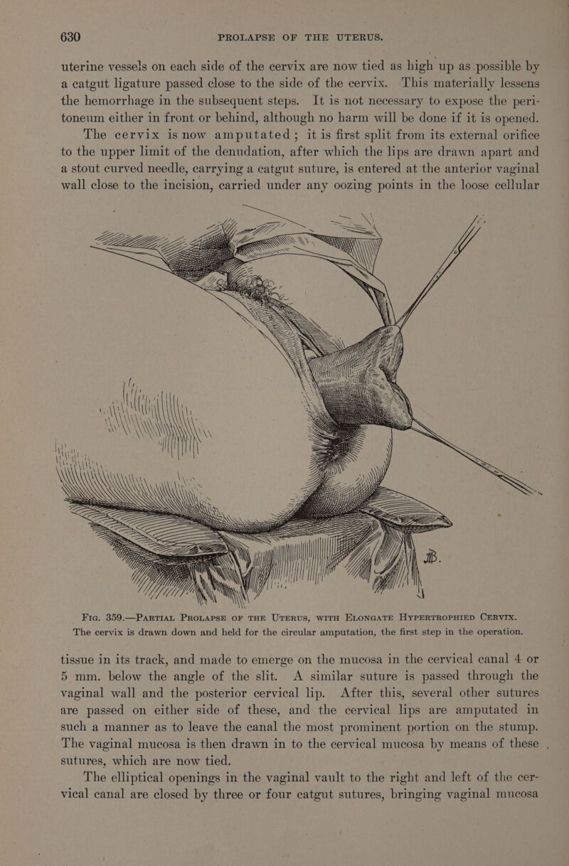 uterine vessels on each side of the cervix are now tied as high up as possible by a catgut ligature passed close to the side of the cervix. This materially lessens the hemorrhage in the subsequent steps. It is not necessary to expose the peri- toneum either in front or behind, although no harm will be done if it is opened. The cervix is now amputated; it is first split from its external orifice to the upper limit of the denudation, after which the lips are drawn apart and a stout curved needle, carrying a catgut suture, is entered at the anterior vaginal wall close to the incision, carried under any oozing points in the loose cellular - ‘ioe = Ss - Lz ; i Ze &lt;i ACh is Mii | N \\ 7 \ \ \\\ a SS SSS \N \ Fig. 359.—PARTIAL PROLAPSE OF THE UTERUS, WITH ELONGATE HYPERTROPHIED CERVIX. The cervix is drawn down and held for the circular amputation, the first step in the operation. tissue in its track, and made to emerge on the mucosa in the cervical canal 4 or 5 mm. below the angle of the slit. A similar suture is passed through the vaginal wall and the posterior cervical lip. After this, several other sutures are passed on either side of these, and: the cervical lips are amputated in such a manner as to leave the canal the most prominent portion on the stump. The vaginal mucosa is then drawn in to the cervical mucosa by means of these sutures, which are now tied. The elliptical openings in the vaginal vault to the right and left of the cer- vical canal are closed by three or four catgut sutures, bringing vaginal mucosa