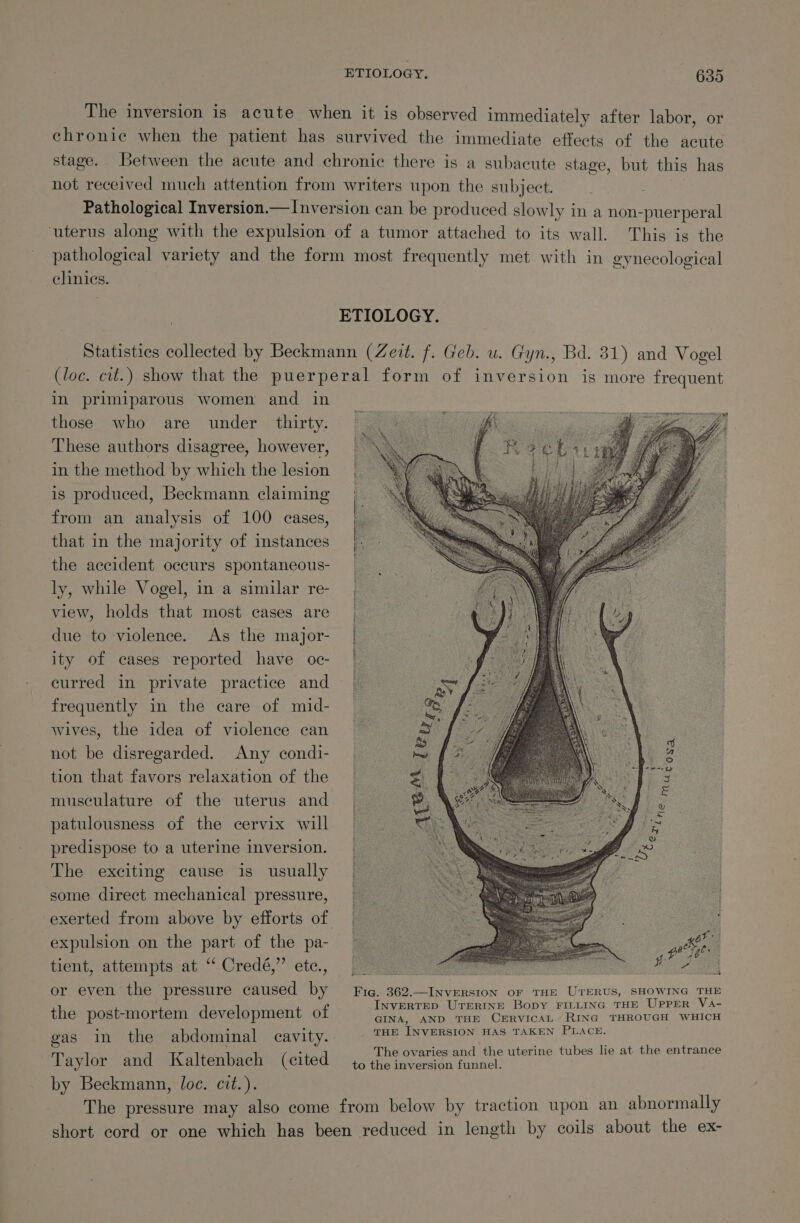 The inversion is acute when it is observed immediately after labor, or chronic when the patient has survived the immediate effects of the acute stage. Between the acute and chronic there is a subacute stage, but this has not received much attention from writers upon the subject. Pathological Inversion.— Inversion can be produced slowly in a non-puerperal ‘uterus along with the expulsion of a tumor attached to its wall. This is the pathological variety and the form most frequently met with in gynecological clinics. ETIOLOGY. Statistics collected by Beckmann (Zeit. f. Geb. u. Gyn., Bd. 31) and Vogel (loc. cit.) show that the puerperal form of inversion is more frequent in primiparous women and in those who are under thirty. These authors disagree, however, in the method by which the lesion is produced, Beckmann claiming from an analysis of 100 cases, that in the majority of instances the accident occurs spontaneous- ly, while Vogel, in a similar re- view, holds that most cases are due to violence. As the major- ity of cases reported have oc- curred in private practice and frequently in the care of mid- wives, the idea of violence can not be disregarded. Any condi- tion that favors relaxation of the musculature of the uterus and patulousness of the cervix will predispose to a uterine inversion. The exciting cause is usually some direct mechanical pressure, exerted from above by efforts of expulsion on the part of the pa- tient, attempts at “ Credé,” ete, (0 | S or even the pressure caused by Fig. S00 eet cnbsion OF THE UTERUS, SHOWING THE INVERTED UTERINE Bopy FILLING THE UPPER Va- the post-mortem development of GINA, AND THE CERVICAL RING THROUGH WHICH gas in the abdominal cavity. THE INVERSION HAS TAKEN PLACE. : The ovaries and the uterine tubes lie at the entrance Taylor and Kaltenbach (cited ~ to the inversion funnel. by Beckmann, loc. cit.). The pressure may also come from below by traction upon an abnormally short cord or one which has been reduced in length by coils about the ex- Ferree ger geigt fe Ae