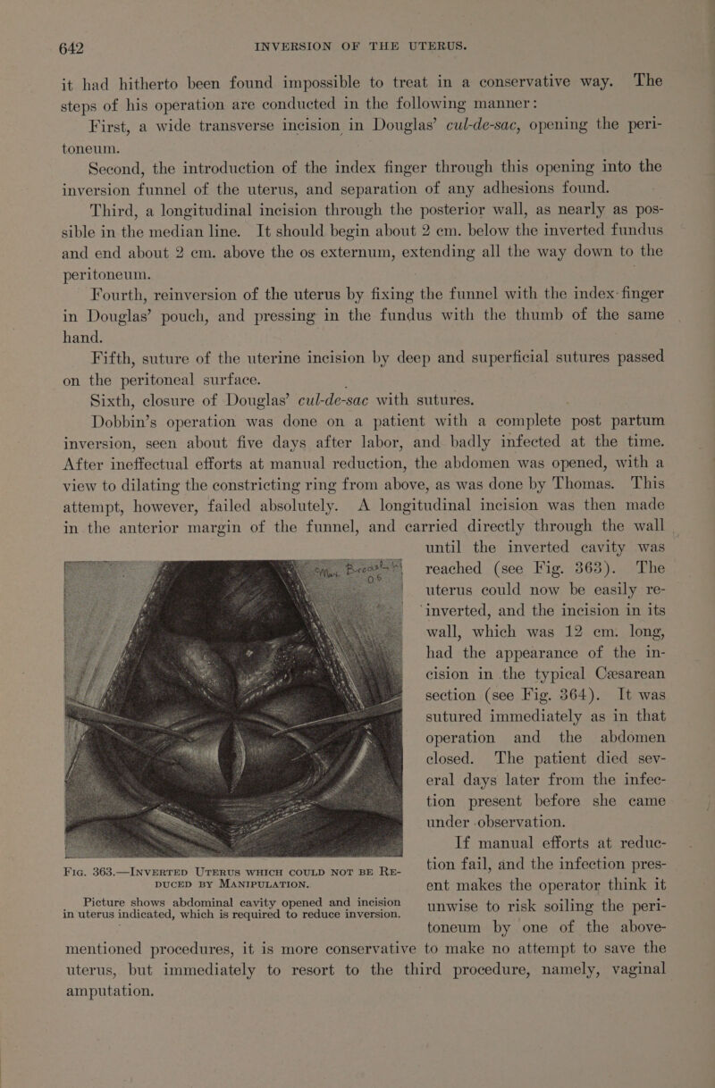 it had hitherto been found impossible to treat in a conservative way. The steps of his operation are conducted in the following manner: First, a wide transverse incision in Douglas’ cul-de-sac, opening the peri- toneum. Second, the introduction of the index finger through this opening into the inversion funnel of the uterus, and separation of any adhesions found. Third, a longitudinal incision through the posterior wall, as nearly as pos- sible in the median line. It should begin about 2 em. below the inverted fundus and end about 2 cm. above the os externum, extending all the way down to the peritoneum. Fourth, reinversion of the uterus by fixing the funnel with the index: finger in Douglas’ pouch, and pressing in the fundus with the thumb of the same hand. Fifth, suture of the uterine incision by deep and superficial sutures passed on the peritoneal surface. Sixth, closure of Douglas’ cul-de-sac with sutures. . Dobbin’s operation was done on a patient with a complete post partum inversion, seen about five days after labor, and badly infected at the time. After ineffectual efforts at manual reduction, the abdomen was opened, with a view to dilating the constricting ring from above, as was done by Thomas. This attempt, however, failed absolutely. A longitudinal incision was then made in the anterior margin of the funnel, and carried directly through the wall _ until the inverted cavity was reached (see Fig. 363). The uterus could now be easily re- ‘inverted, and the incision in its wall, which was 12 cm. long, had the appearance of the in- cision in the typical Cesarean section (see Fig. 364). It was sutured immediately as in that operation and the abdomen closed. The patient died sev- eral days later from the infec- tion present before she came under observation. If manual efforts at reduc- tion fail, and the infection pres- Picture shows abdominal cavity opened and incision in uterus indicated, which is required to reduce inversion. unwise to risk soiling the ee toneum by one of the above- mentioned procedures, it is more conservative to make no attempt to save the uterus, but immediately to resort to the third procedure, namely, vaginal amputation. , |