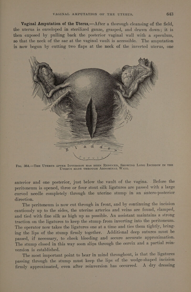 Vaginal Amputation of the Uterus—After a thorough cleansing of the field, the uterus is enveloped in sterilized gauze, grasped, and drawn down; it is then exposed by pulling back the posterior vaginal wall with a speculum, so that the neck of the sac at the vaginal vault is accessible. The amputation is now begun by cutting two flaps at the neck of the inverted uterus, one Fic, 364.—Tue Uterus AFTER INVERSION HAS BEEN REDUCED, SHOwING Lone INCISION IN THE UTERUS MADE THROUGH ABDOMINAL WALL. anterior and one posterior, just below the vault of the vagina. Before the peritoneum is opened, three or four stout silk ligatures are passed with a large curved needle completely through the uterine stump in an antero-posterior direction. | | | The peritoneum is now cut through in front, and by continuing the incision cautiously up to the sides, the uterine arteries and veins are found, clamped, and tied with fine silk as high up as possible. An assistant maintains a strong traction on the ligatures to keep the stump from inverting into the peritoneum. The operator now takes the ligatures one at a time and ties them tightly, bring- ing the lips of the stump firmly together. Additional deep sutures must be passed, if necessary, to check bleeding and secure accurate approximation. The stump closed in this way soon slips through the cervix and a partial rein- version is established. The most important point to bear in mind throughout, is that the ligatures passing through the stump must keep the lips of the wedge-shaped incision firmly approximated, even after reinversion has occurred. A dry dressing