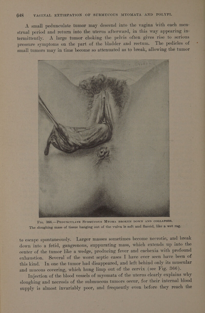 A small pedunculate tumor may descend into the vagina with each men- strual period and return into the uterus afterward, in this way appearing in- termittently. A large tumor choking the pelvis often gives rise to serious pressure symptoms on the part of the bladder and rectum. The pedicles of small tumors may in time become so attenuated as to break, allowing the tumor Fic. 366.—PEpUNCULATE SuBMUCOUS MYoMA BROKEN DOWN AND COLLAPSED. The sloughing mass of tissue hanging out of the vulva is soft and flaccid, like a wet rag. ty escape spontaneously. Larger masses sometimes become necrotic, and break down into a fetid, gangrenous, suppurating mass, which extends up into the center of the tumor like a wedge, producing fever and cachexia with profound exhaustion. Several of the worst septic cases I have ever seen have been of this kind. In one the tumor had disappeared, and left behind only its muscular and mucous covering, which hung limp out of the cervix (see Fig. 366). Injection of the blood vessels of myomata of the uterus clearly explains why sloughing and necrosis of the submucous tumors occur, for their internal blood supply is almost invariably poor, and frequently even before they reach the