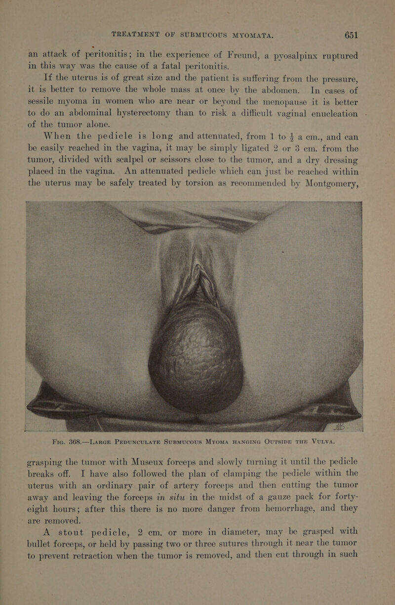 an attack of peritonitis; in the experience of Freund, a pyosalpinx ruptured in this way was the cause of a fatal peritonitis. If the uterus is of great size and the patient is suffering from the pressure, it is better to remove the whole mass at once by the abdomen. In eases of sessile myoma in women who are near or beyond the menopause it is better to do an abdominal hysterectomy than to risk a difficult vaginal enucleation of the tumor alone. When the pedicle is long and attenuated, from 1 to $ a em., and can be easily reached in the vagina, it may be simply ligated 2 or 3 em. from the tumor, divided with scalpel or scissors close to the tumor, and a dry dressing placed in the vagina. An attenuated pedicle which can just be reached within the uterus may be safely treated by torsion as recommended by Montgomery, grasping the tumor with Museux forceps and slowly turning it until the pedicle breaks off. I have also followed the plan of clamping the pedicle within the uterus with an ordinary pair of artery forceps and then cutting the tumor away and leaving the forceps in situ in the midst of a gauze pack for forty- eight hours; after this there is no more danger from hemorrhage, and they are removed. A stout pedicle, 2 cm. or more in diameter, may be grasped with bullet forceps, or held by passing two or three sutures through it near the tumor to prevent retraction when the tumor is removed, and then cut through in such \