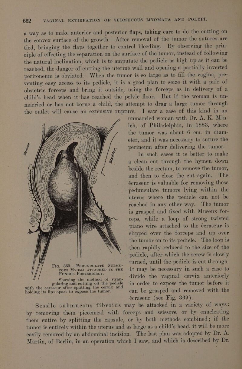 a way as to make anterior and posterior flaps, taking care to do the cutting on the convex surface of the growth. After removal of the tumor the sutures are tied, bringing the flaps together to control bleeding. By observing the prin- ciple of effecting the separation on the surface of the tumor, instead of following the natural inclination, which is to amputate the pedicle as high up as it can be reached, the danger of cutting the uterine wall and opening a partially inverted peritoneum is obviated. When the tumor is so large as to fill the vagina, pre- venting easy access to its pedicle, it is a good plan to seize it with a pair of obstetric forceps and bring it outside, using the forceps as in delivery of a child’s head when it has reached the pelvic floor. But if the woman is un- married or has not borne a child, the attempt to drag a large tumor through the outlet will cause an extensive rupture. I saw a case of this kind in an unmarried woman with Dr. A. K. Min- ich, of Philadelphia, in 1883, where the tumor was about 6 em. in diam- eter, and it was necessary to suture the perineum after delivering the tumor. In such cases it is better to make a clean cut through the hymen down beside the rectum, to remove the tumor, and then to close the cut again. The écraseur is valuable for removing those peduneculate tumors lying within the uterus where the pedicle can not be reached in any other way. The tumor is grasped and fixed with Museux for- ceps, while a loop of strong twisted piano wire attached to the écraseur is slipped over the forceps and up over the tumor on to its pedicle. The loop is then rapidly reduced to the size of the pedicle, after which the screw is slowly Sr ee tae aa aay turned, until the pedicle is cut through. | core aie nis hen ee It may be necessary in such a case to Shee eh eon eee tcfeatran: divide the vaginal cervix anteriorly gulating and cutting off the pedicle jin order to expose the tumor before it with the écraseur after splitting the cervix and ‘ holding its lips apart to expose the tumor. ean be erasped and removed with the éeraseur (see Fig. 369). Sessile submucous fibroids may be attacked in a variety of ways: by removing them piecemeal with forceps and scissors, or by enucleating them entire by splitting the capsule, or by both methods combined; if the tumor is entirely within the uterus and as large as a child’s head, it will be more easily removed by an abdominal incision. The last plan was adopted by Dr. A. Martin, of Berlin, in an operation which I saw, and which is described by Dr. WS (Wy