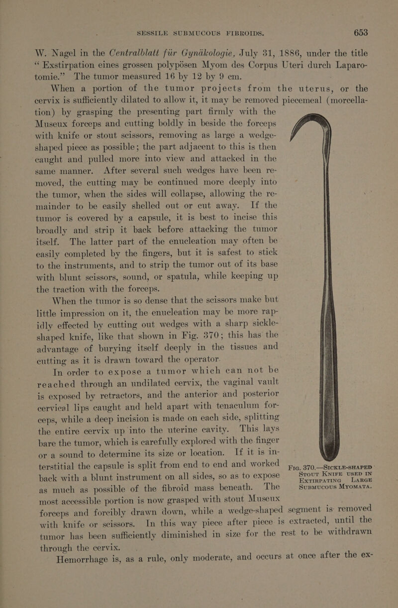 tomie.”” The tumor measured 16 by 12 by 9 cm. tion) by grasping the presenting part firmly with the Museux forceps and cutting boldly in beside the forceps with knife or stout scissors, removing as large a wedge- shaped piece as possible; the part adjacent to this is then caught and pulled more into view and attacked in. the same manner. After several such wedges have been re- moved, the cutting may be continued more deeply into the tumor, when the sides will collapse, allowing the re- mainder to be easily shelled out or cut away. If the tumor is covered by a capsule, it is best to incise this broadly and strip it back before attacking the tumor itself. The latter part of the enucleation may often be easily completed by the fingers, but it is safest to stick to the instruments, and to strip the tumor out of its base with blunt scissors, sound, or spatula, while keeping up the traction with the forceps. When the tumor is so dense that the scissors make but little impression on it, the enucleation may be more rap- idly effected by cutting out wedges with a sharp sickle- shaped knife, like that shown in Fig. 370; this has the advantage of burying itself deeply in the tissues and cutting as it is drawn toward the operator. In order to expose a tumor which can not be reached through an undilated cervix, the vaginal vault is exposed by retractors, and the anterior and posterior cervical lips caught and held apart with tenaculum for- ceps, while a deep incision is made on each side, splitting the entire cervix up into the uterine cavity. This lays bare the tumor, which is carefully explored with the finger or a sound to determine its size or location. If it is in- terstitial the capsule is split from end to end and worked back with a blunt instrument on all sides, so as to expose as much as possible of the fibroid mass beneath. The most accessible portion is now grasped with stout Museux Fic. 370.—SICKLE-SHAPED © Strout KNIFE USED IN EXTIRPATING LARGE Suspmucous MYOMATA. through the cervix.