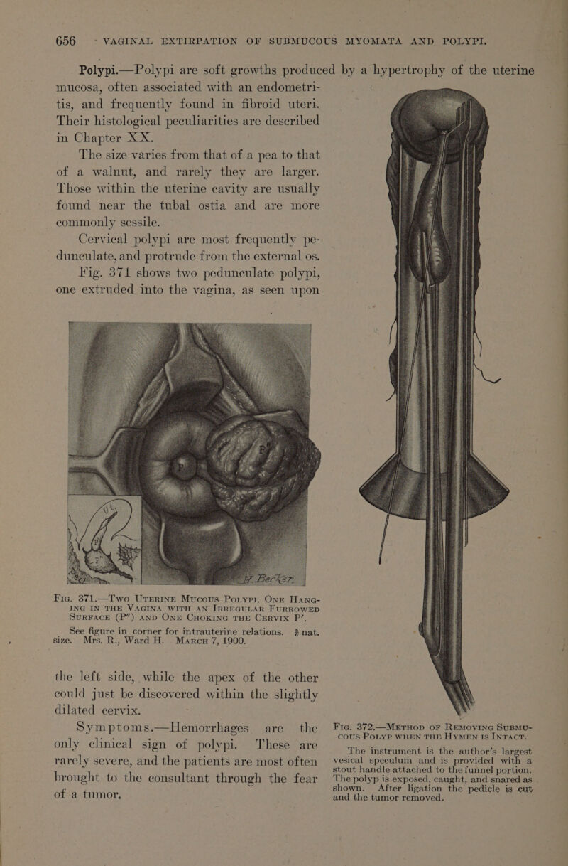 mucosa, often associated with an endometri- tis, and frequently found in fibroid uteri. Their histological peculiarities are described in Chapter XX. The size varies from that of a pea to that of a walnut, and rarely they are larger. Those within the uterine cavity are usually found near the tubal ostia and are more commonly sessile. Cervical polypi are most frequently pe- dunculate, and protrude from the external os. Fig. 871 shows two pedunculate polypi, one extruded into the vagina, as seen upon Fig. 371.—Two UTrerine Mucous Potyri, ONE Hane- ING IN THE VAGINA WITH AN IRREGULAR FURROWED SURFACE (P”) AnD ONE CHOKING THE CERVIX P’. See figure in corner for intrauterine relations. &amp; nat. size. Mrs. R., Ward H. Marcu 7, 1900. the left side, while the apex of the other could just be discovered within the slightly Symptoms.—Hemorrhages are the only clinical sign of polypi. These are rarely severe, and the patients are most often brought to the consultant through the fear of a tumor. Fic. 372.—MeEtTHOD oF REMOVING SUBMU- cous PoLYP WHEN THE HyMEN Is INTACT. The instrument is the author’s largest vesical speculum and is provided with a stout handle attached to the funnel portion. shown. After ligation the pedicle is cut and the tumor removed. ——————— CU ~~