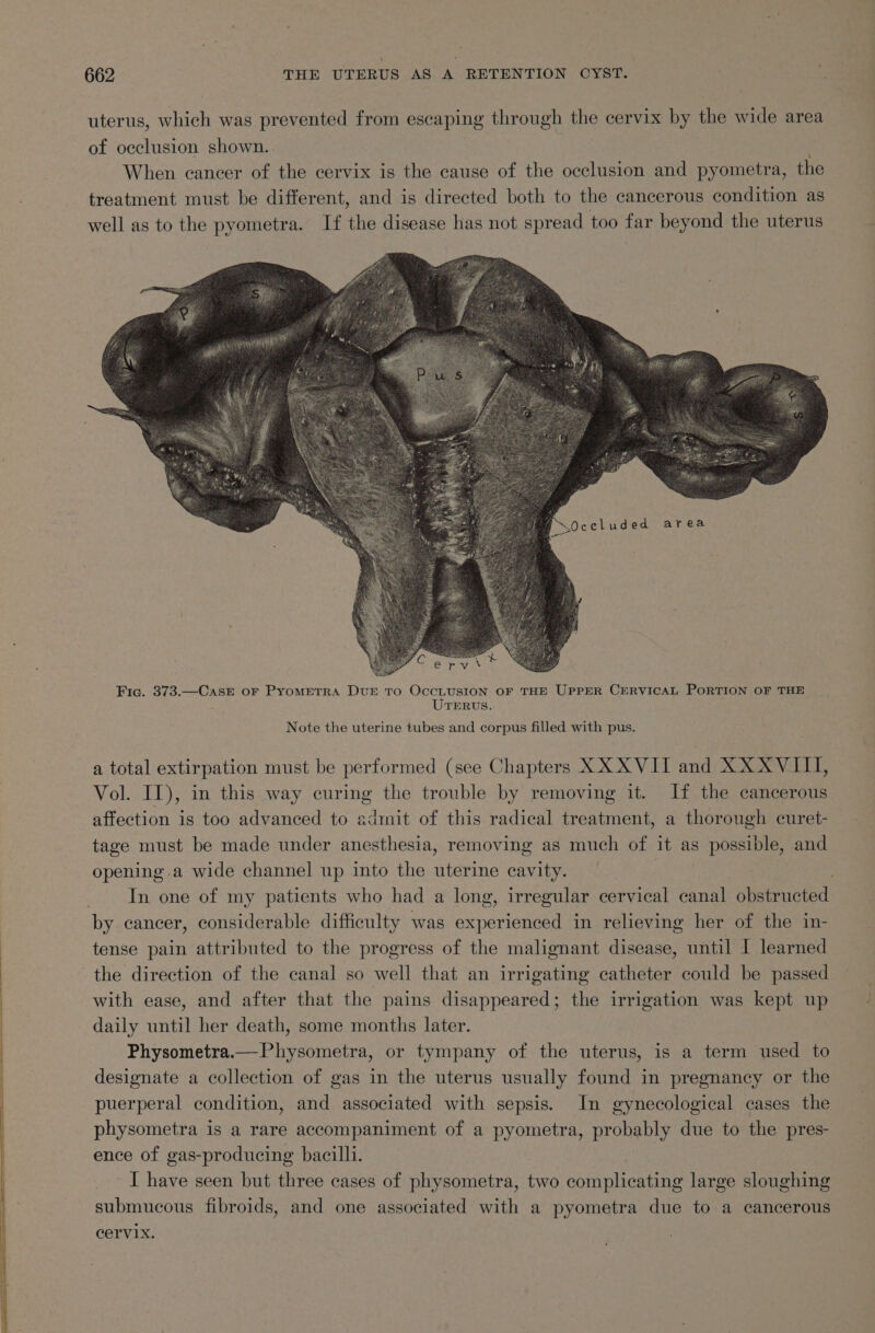 “Occluded area Fic. 373.—CasE oF PYyomMeTRA DUE TO OccLUSION OF THE UPPER CERVICAL PORTION OF THE UTERUS. Note the uterine tubes and corpus filled with pus. a total extirpation must be performed (see Chapters XX XVIT and XX XVIII, Vol. II), in this way curing the trouble by removing it. If the cancerous affection is too advanced to admit of this radical treatment, a thorough curet- tage must be made under anesthesia, removing as much of it as possible, and opening.a wide channel up into the uterine cavity. ! In one of my patients who had a long, irregular cervical canal obstructed by cancer, considerable difficulty was experienced in relieving her of the in- tense pain attributed to the progress of the malignant disease, until I learned with ease, and after that the pains disappeared; the irrigation was kept up daily until her death, some months later. Physometra.—Physometra, or tympany of the uterus, is a term used to designate a collection of gas in the uterus usually found in pregnancy or the puerperal condition, and associated with sepsis. In gynecological cases the physometra is a rare accompaniment of a pyometra, prone bly due to the pres- ence of gas-producing bacilli. -T have seen but three cases of physometra, two Mera r uae large sloughing submucous fibroids, and one associated with a pyometra due to a cancerous cervix.