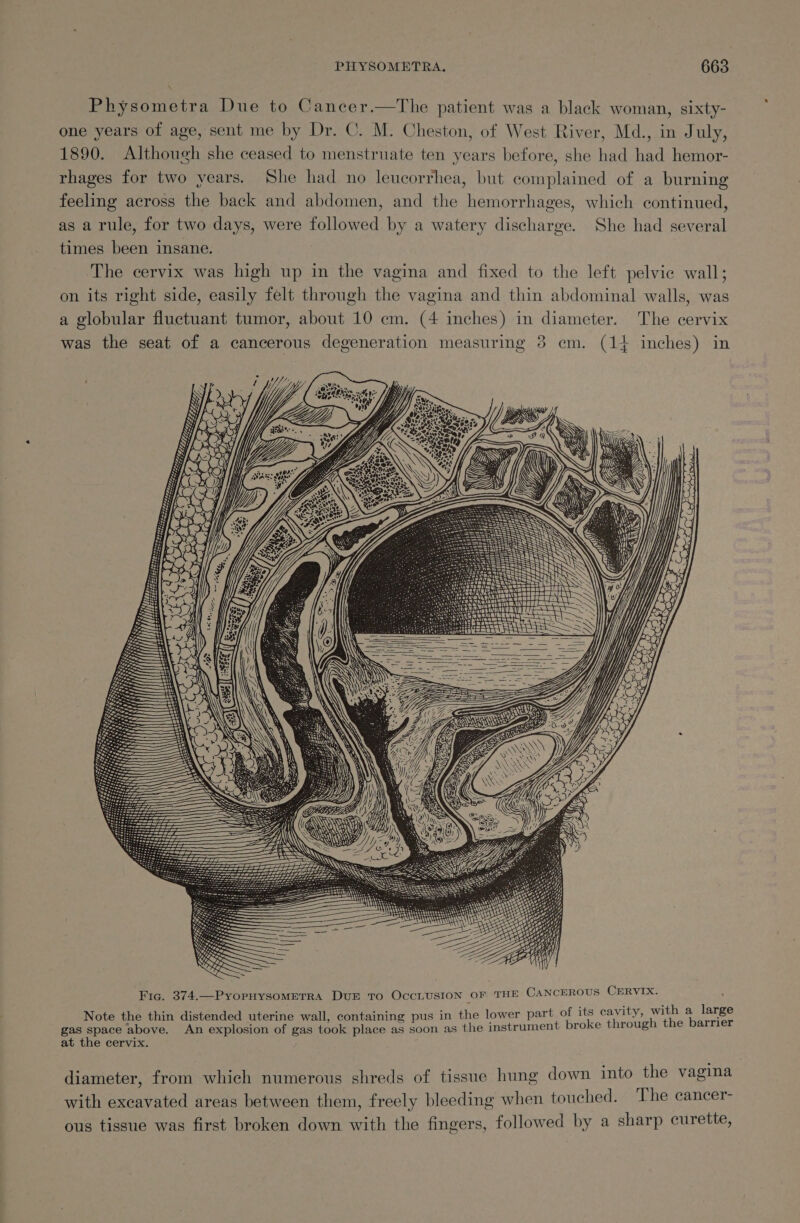 Physometra Due to Cancer.—tThe patient was a black woman, sixty- one years of age, sent me by Dr. C. M. Cheston, of West River, Md., in July, 1890. Although she ceased to menstruate ten years before, she had had hemor- rhages for two years. She had no leucorrhea, but complained of a burning feeling across the back and abdomen, and the hemorrhages, which continued, as a rule, for two days, were followed by a watery discharge. She had several times been insane. The cervix was high up in the vagina and fixed to the left pelvic wall; on its right side, easily felt through the vagina and thin abdominal walls, was a globular fluctuant tumor, about 10 cm. (4 inches) in diameter. The cervix was the seat of a cancerous degeneration measuring 8 cm. (14 inches) in andi : ae ; its cavity, with a large Note the thin distended uterine wall, containing pus in the lower part of its cavity, : gas space above. An explosion of gas took place as soon as the instrument broke through the barrier at the cervix. ° e e = ol diameter, from which numerous shreds of tissue hung down into the vagina with excavated areas between them, freely bleeding when touched. The cancer- ous tissue was first broken down with the fingers, followed by a sharp curette,