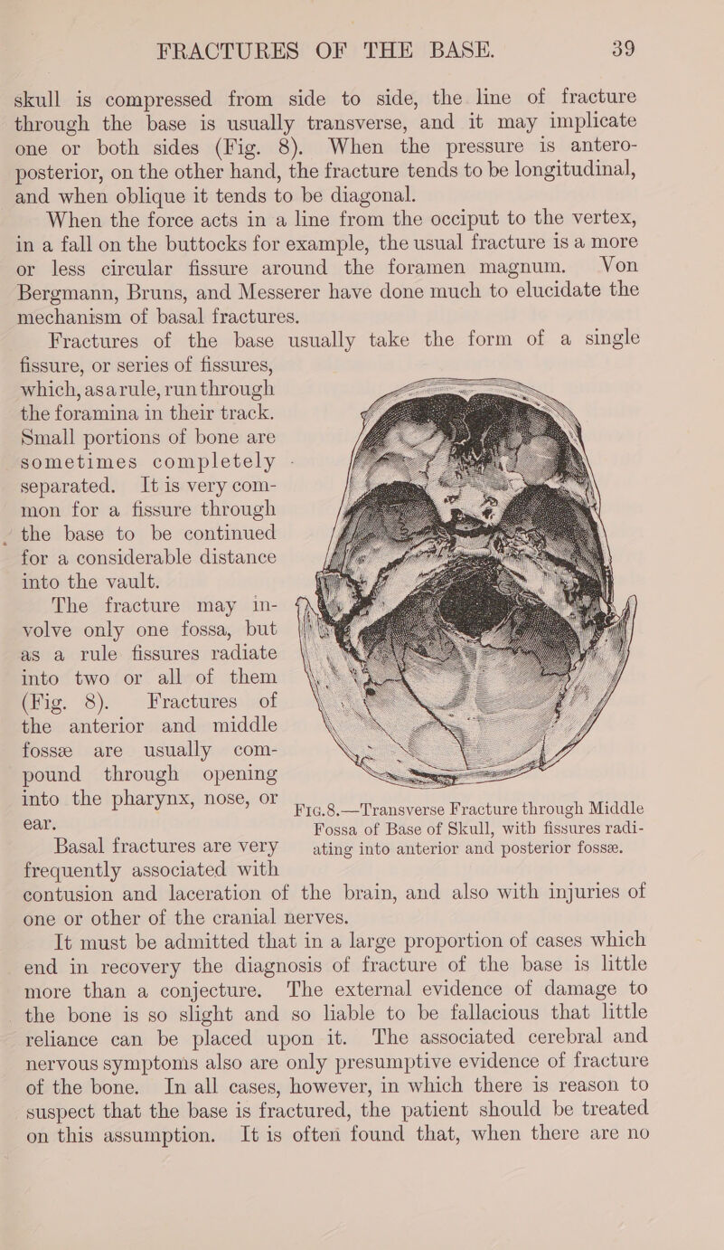 skull is compressed from side to side, the line of fracture through the base is usually transverse, and it may implicate one or both sides (Fig. 8). When the pressure is antero- posterior, on the other hand, the fracture tends to be longitudinal, and when oblique it tends to be diagonal. When the force acts in a line from the occiput to the vertex, in a fall on the buttocks for example, the usual fracture is a more or less circular fissure around the foramen magnum, Von Bergmann, Bruns, and Messerer have done much to elucidate the mechanism of basal fractures. Fractures of the base usually take the form of a single fissure, or series of fissures, which, asarule, run through the foramina in their track. Small portions of bone are sometimes completely separated. It is very com- mon for a fissure through the base to be continued for a considerable distance into the vault. The fracture may 1in- volve only one fossa, but as a rule fissures radiate into two or all of them (Fig. 8). Fractures of the anterior and middle fosse are usually com- pound through opening oo es nie ight F1c.8.—Transverse Fracture through Middle por Fossa of Base of Skull, with fissures radi- Basal fractures are very ating into anterior and posterior fosse. frequently associated with contusion and laceration of the brain, and also with injuries of one or other of the cranial nerves. It must be admitted that in a large proportion of cases which end in recovery the diagnosis of fracture of the base 1s little more than a conjecture. The external evidence of damage to the bone is so slight and so liable to be fallacious that little reliance can be placed upon it. The associated cerebral and nervous symptonis also are only presumptive evidence of fracture of the bone. In all cases, however, in which there is reason to suspect that the base is fractured, the patient should be treated on this assumption. It is often found that, when there are no