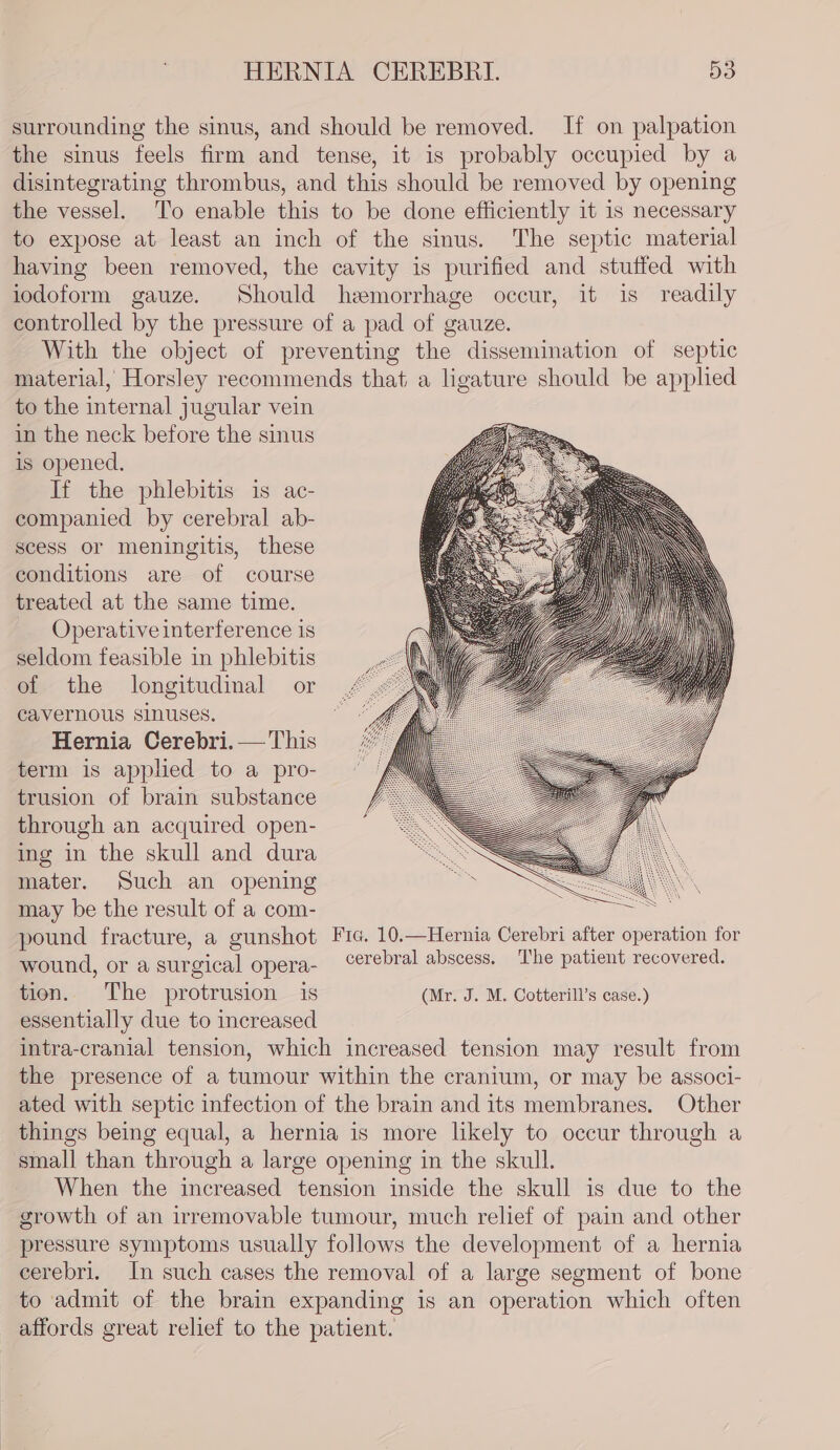 surrounding the sinus, and should be removed. If on palpation the sinus feels firm and tense, it is probably occupied by a disintegrating thrombus, and this should be removed by opening the vessel. ‘To enable this to be done efficiently it 1s necessary to expose at least an inch of the sinus. The septic material having been removed, the cavity is purified and stuffed with iodoform gauze. Should hemorrhage occur, it is readily controlled by the pressure of a pad of gauze. With the object of preventing the dissemination of septic material, Horsley recommends that a ligature should be applied to the internal jugular vein in the neck before the sinus is opened. If the phlebitis is ac- companied by cerebral ab- scess or meningitis, these conditions are of course treated at the same time. Operative interference is seldom feasible in phlebitis of the longitudinal or cavernous sinuses. Hernia Cerebri.— This term is applied to a pro- trusion of brain substance through an acquired open- ing in the skull and dura mater. Such an opening may be the result of a com- pound fracture, a gunshot Fie. 10.—Hernia Cerebri after operation for wound, or a surgical opera- cerebral abscess. ‘The patient recovered. tion. The protrusion is (Mr. J. M. Cotterill’s case.) essentially due to increased intra-cranial tension, which increased tension may result from the presence of a tumour within the cranium, or may be associ- ated with septic infection of the brain and its membranes. Other things being equal, a hernia is more likely to occur through a small than through a large opening in the skull. When the increased tension inside the skull is due to the growth of an irremovable tumour, much relief of pain and other pressure symptoms usually follows the development of a hernia cerebri. In such cases the removal of a large segment of bone to admit of the brain expanding is an operation which often affords great relief to the patient.