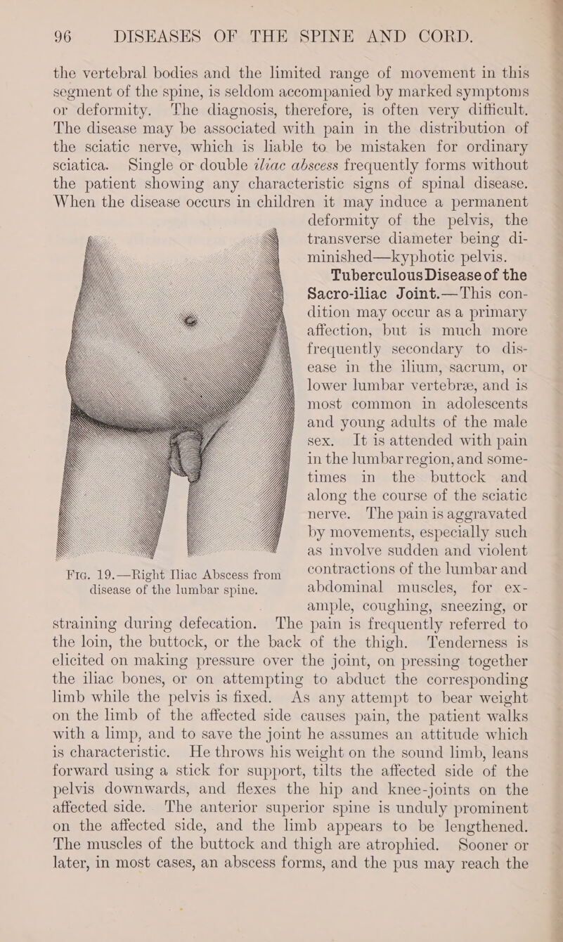 the vertebral bodies and the limited range of movement in this segment of the spine, is seldom accompanied by marked symptoms or deformity. The diagnosis, therefore, is often very difficult. The disease may be associated with pain in the distribution of the sciatic nerve, which is lable to be mistaken for ordinary sciatica. Single or double iliac abscess frequently forms without the patient showing any characteristic signs of spinal disease. When the disease occurs in children it may induce a permanent deformity of the pelvis, the transverse diameter being di- minished—kyphotic pelvis. Tuberculous Disease of the Sacro-iliac Joint.—This con- dition may occur as a primary affection, but is much more frequently secondary to dis- ease in the illum, sacrum, or lower lumbar vertebrze, and is most common in adolescents and young adults of the male sex. It is attended with pain in the lumbar region, and some- times in the buttock and along the course of the sciatic nerve. ‘The pain is aggravated by movements, especially such \ \ as involve sudden and violent j iGo OP ORI o hte inet bacesd trom contractions of the lumbar and disease of the lumbar spine. abdominal muscles, for ex- ? ample, coughing, sneezing, or straining during defecation. The pain is frequently referred to the loin, the buttock, or the back of the thigh. Tenderness is elicited on making pressure over the joint, on pressing together the iliac bones, or on attempting to abduct the corresponding limb while the pelvis is fixed. As any attempt to bear weight on the limb of the affected side causes pain, the patient walks with a limp, and to save the joint he assumes an attitude which is characteristic. He throws his weight on the sound limb, leans forward using a stick for support, tilts the affected side of the pelvis downwards, and flexes the hip and knee-joints on the affected side.. The anterior superior spine is unduly prominent on the affected side, and the limb appears to be lengthened. The muscles of the buttock and thigh are atrophied. Sooner or later, in most cases, an abscess forms, and the pus may reach the